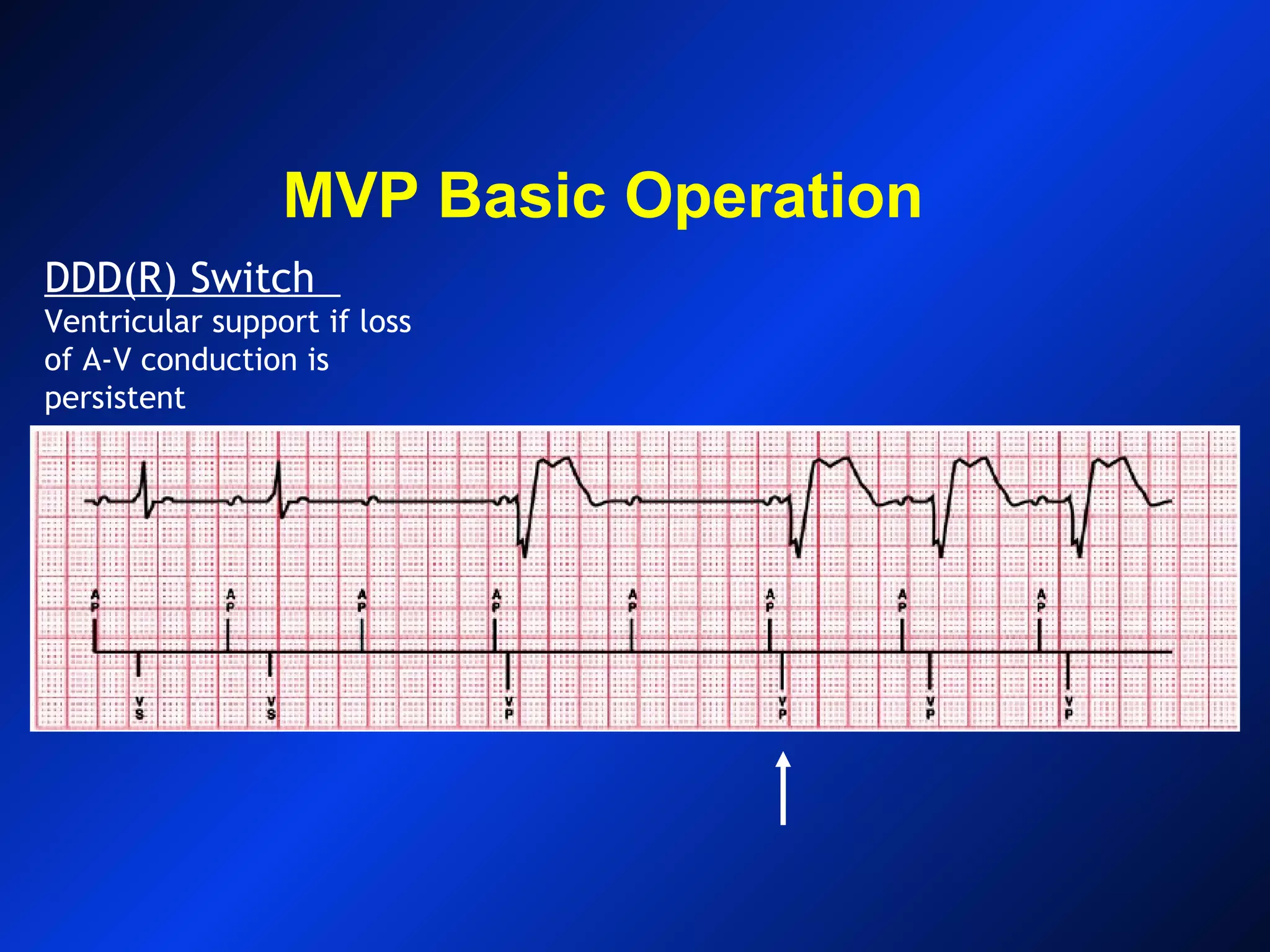 MVP Basic Operation
DDD(R) Switch
Ventricular support if loss
of A-V conduction is
persistent
 