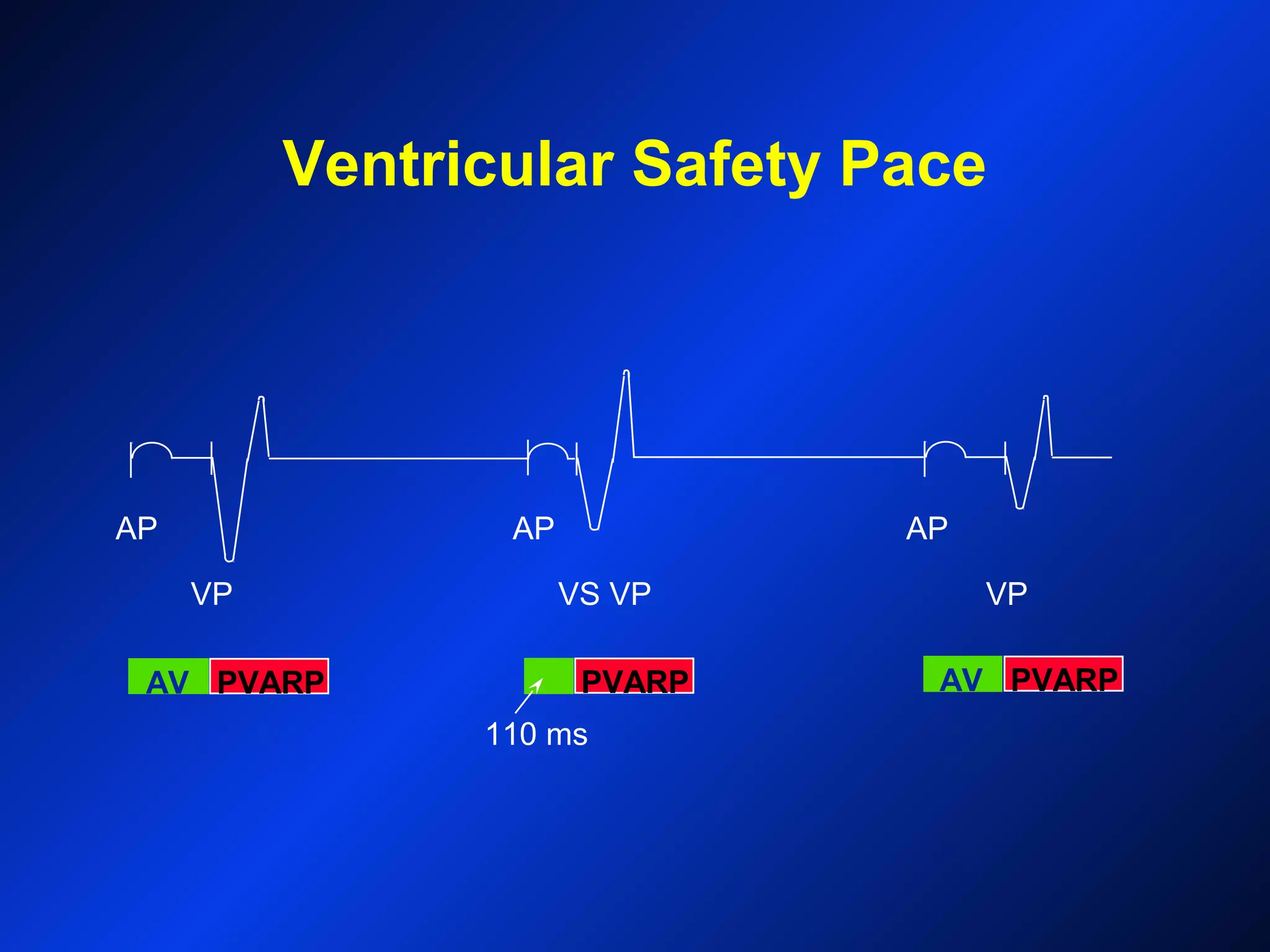 PVARP
Ventricular Safety Pace
AV PVARP PVARP AV
110 ms
VS VPVP VP
AP APAP
 