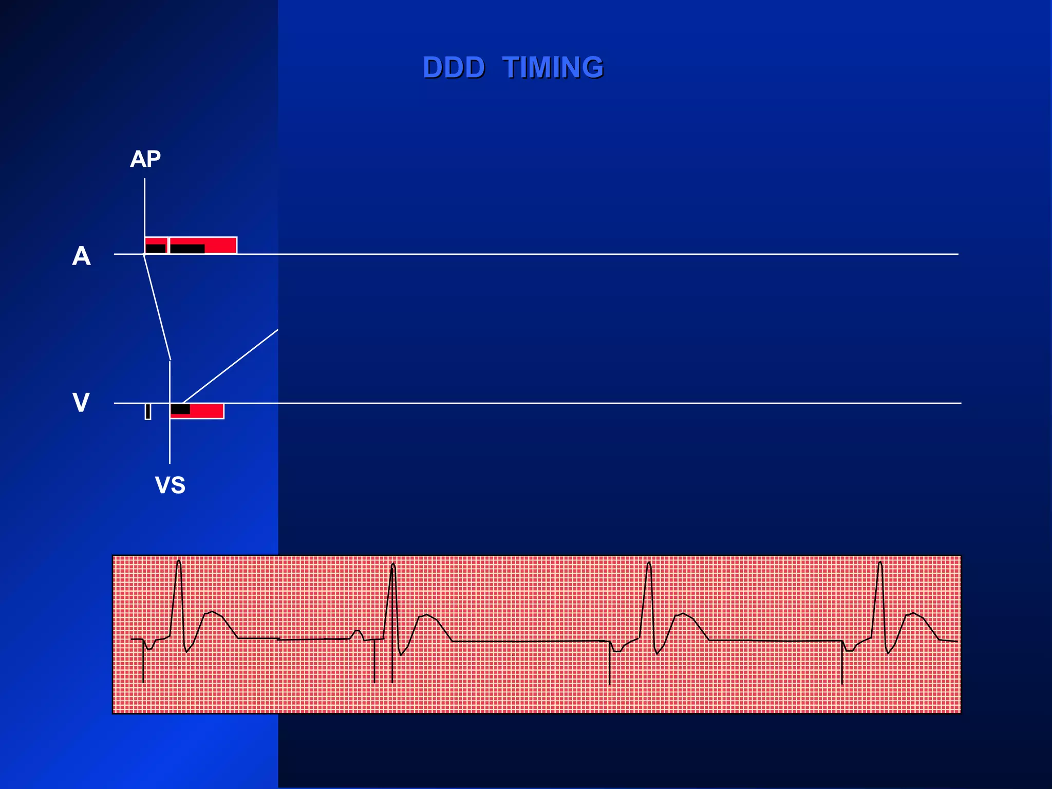VS VS VS
AP APAPAP
A
V
DDD TIMINGDDD TIMING
 