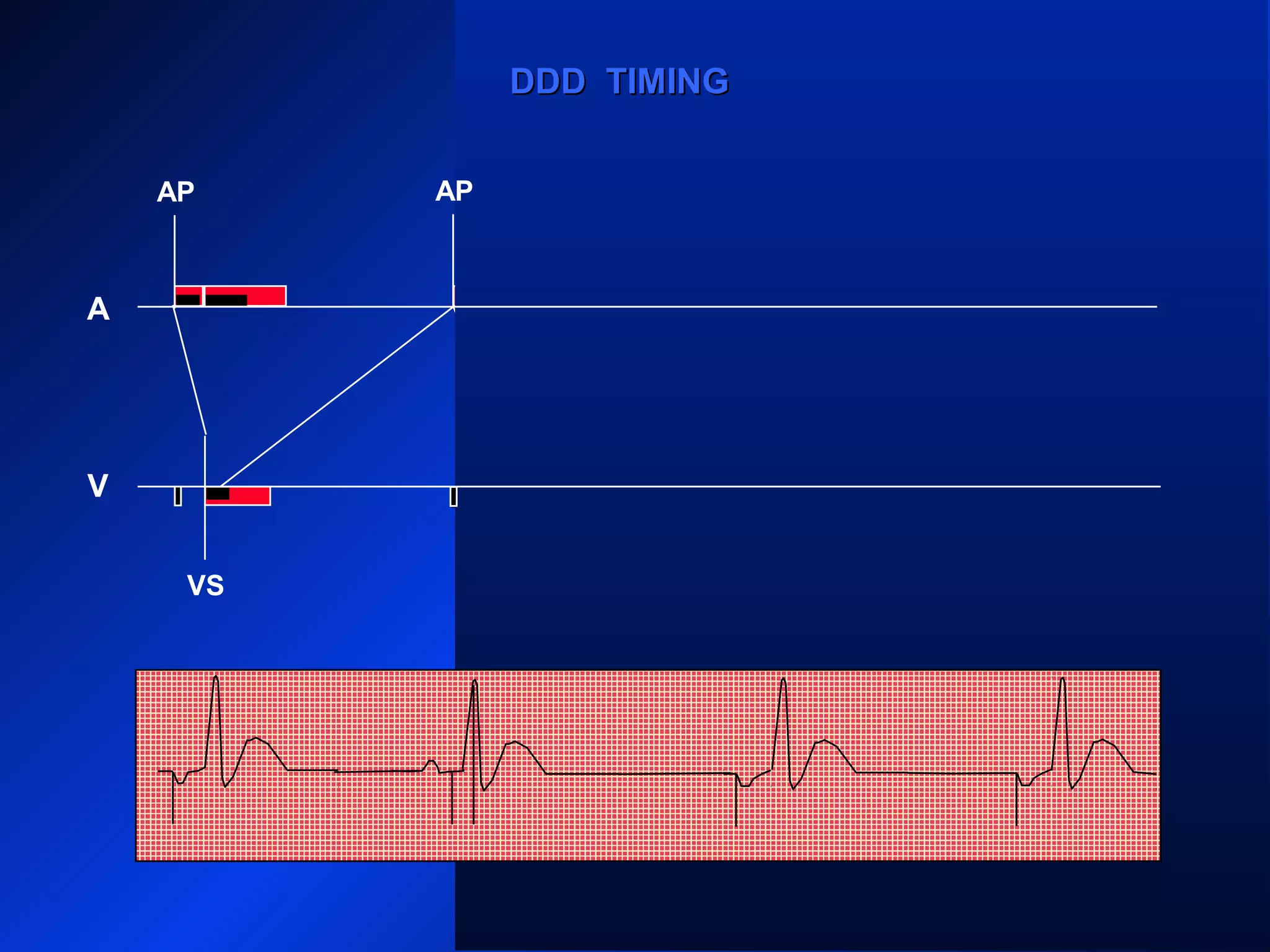 VS VS VS
AP APAP
A
V
DDD TIMINGDDD TIMING
AP
 