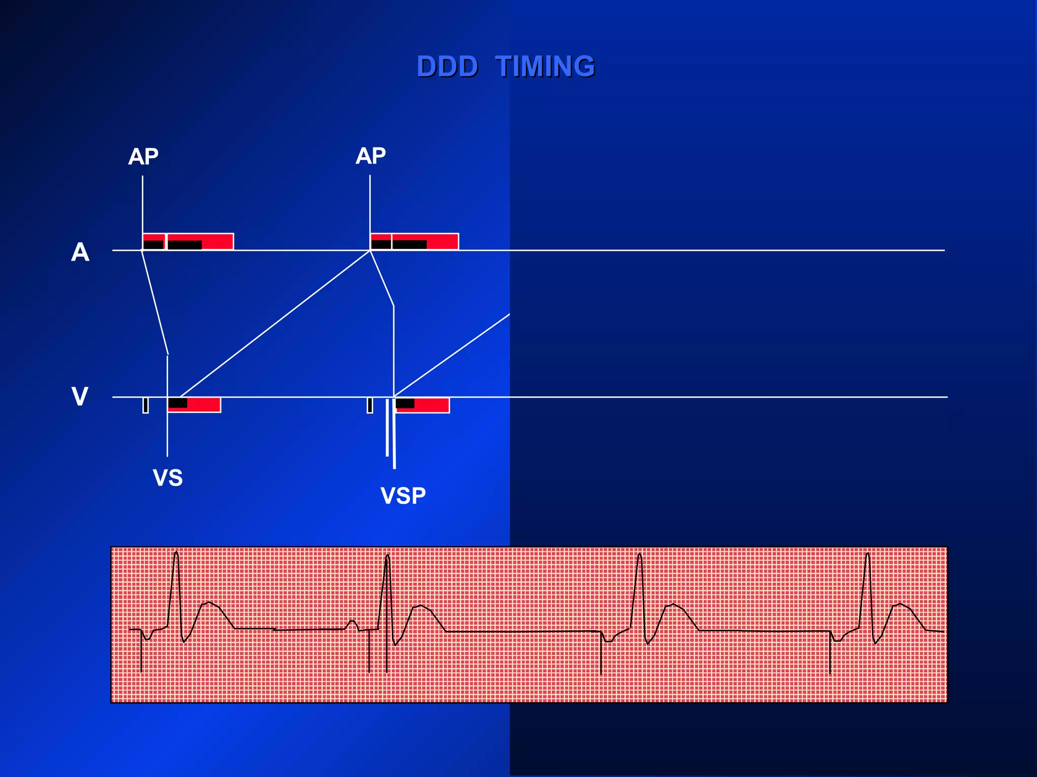 VS VS VS
AP AP AP
VSP
AP
DDD TIMINGDDD TIMING
A
V
 