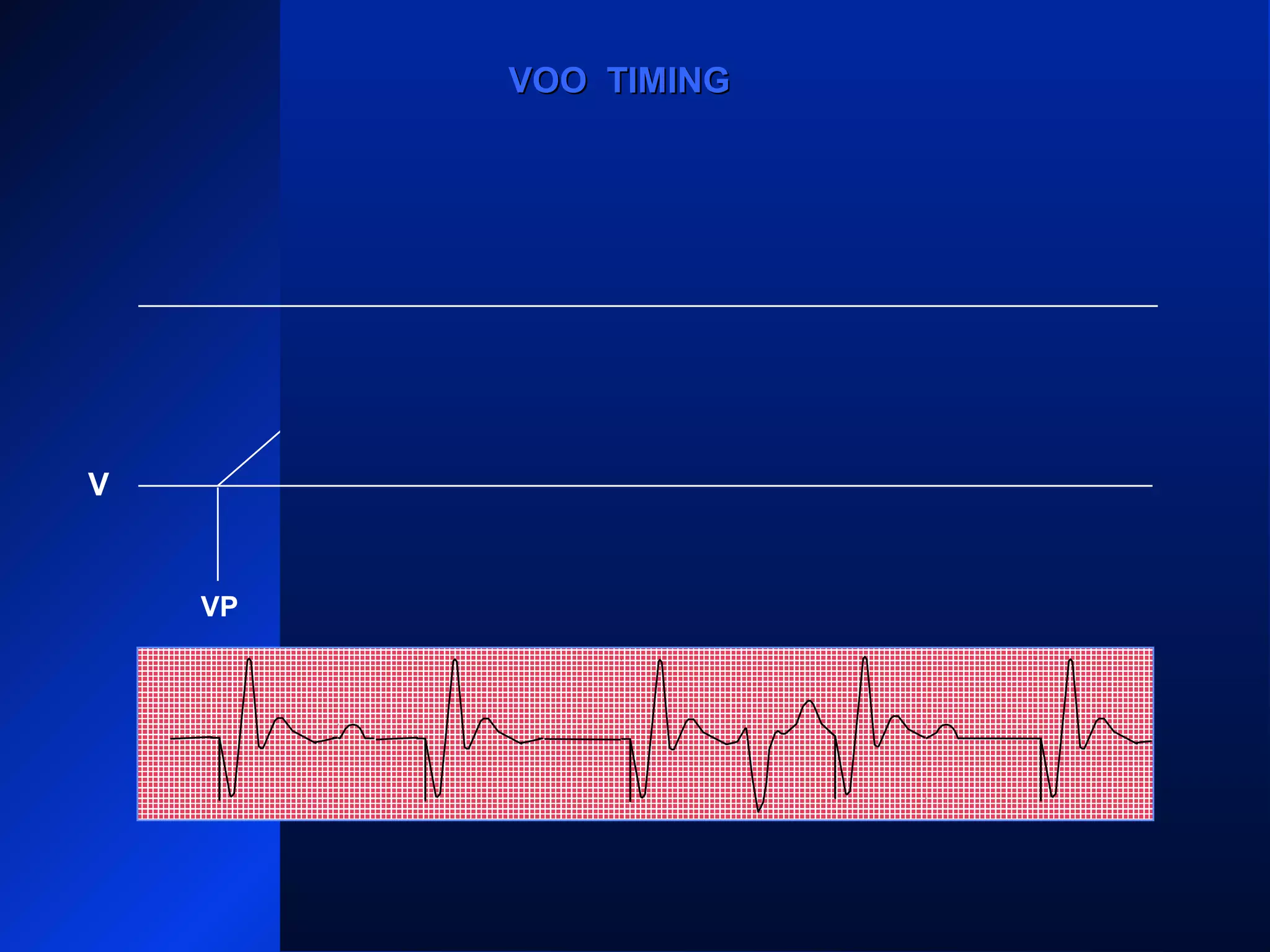 VP VPVPVP VP
VOO TIMINGVOO TIMING
V
 