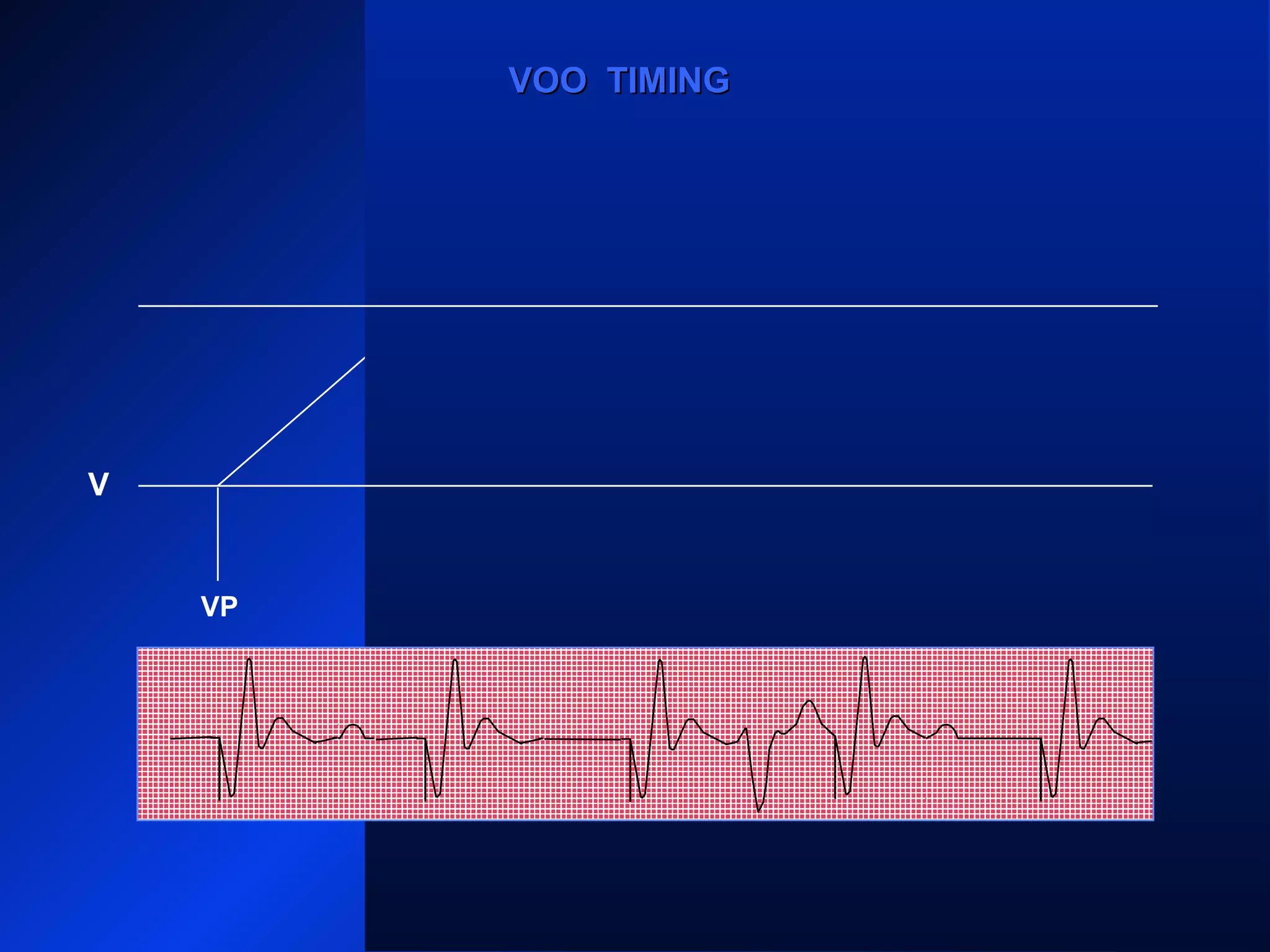 VP VPVPVP VP
VOO TIMINGVOO TIMING
V
 