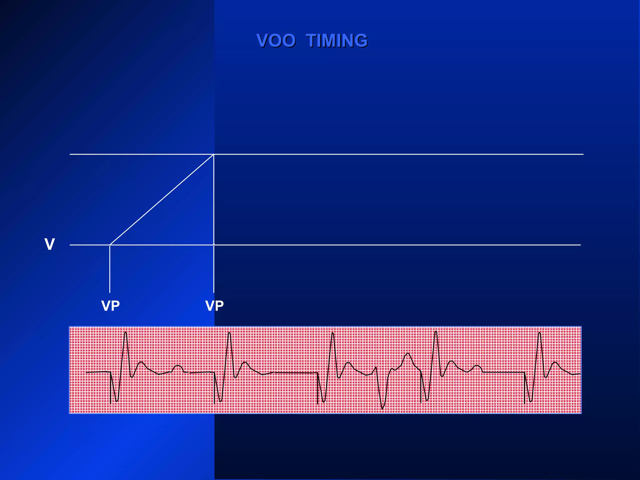 VP VPVPVPVP
VOO TIMINGVOO TIMING
V
 