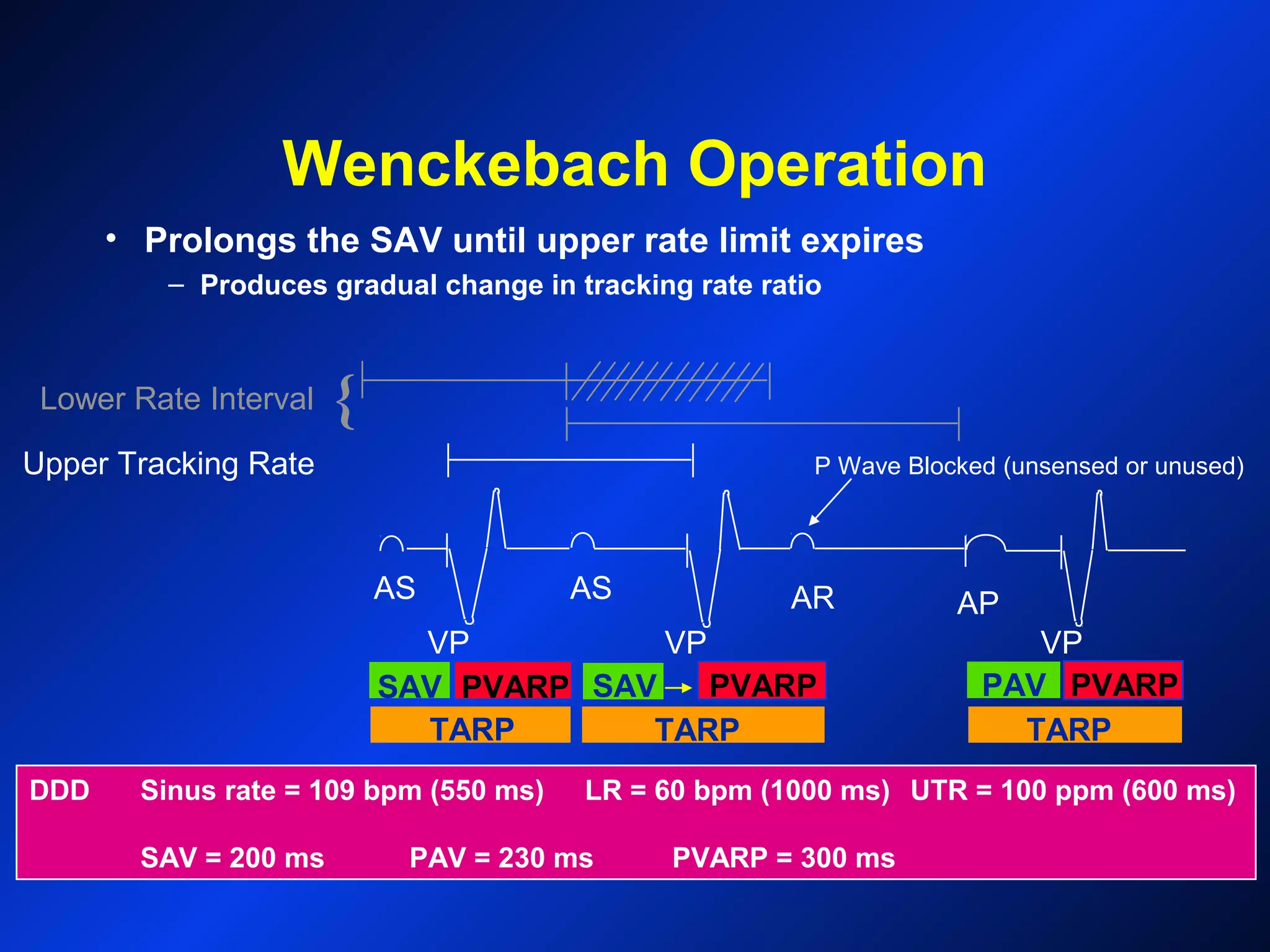 PVARP
Wenckebach Operation
Upper Tracking Rate
Lower Rate Interval {
AS AS AR AP
VPVP VP
TARP
SAV PAV PVARPSAV PVARP
P Wave Blocked (unsensed or unused)
DDD Sinus rate = 109 bpm (550 ms) LR = 60 bpm (1000 ms) UTR = 100 ppm (600 ms)
SAV = 200 ms PAV = 230 ms PVARP = 300 ms
• Prolongs the SAV until upper rate limit expires
– Produces gradual change in tracking rate ratio
TARP TARP
 