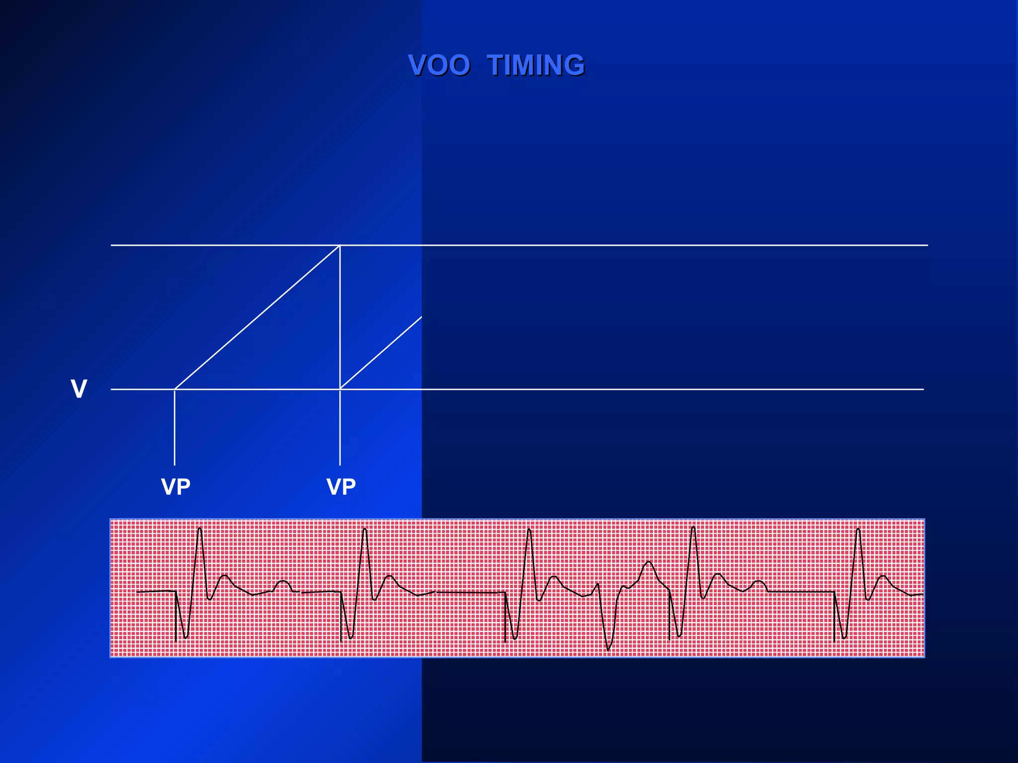 VP VP VPVPVP
VOO TIMINGVOO TIMING
V
 