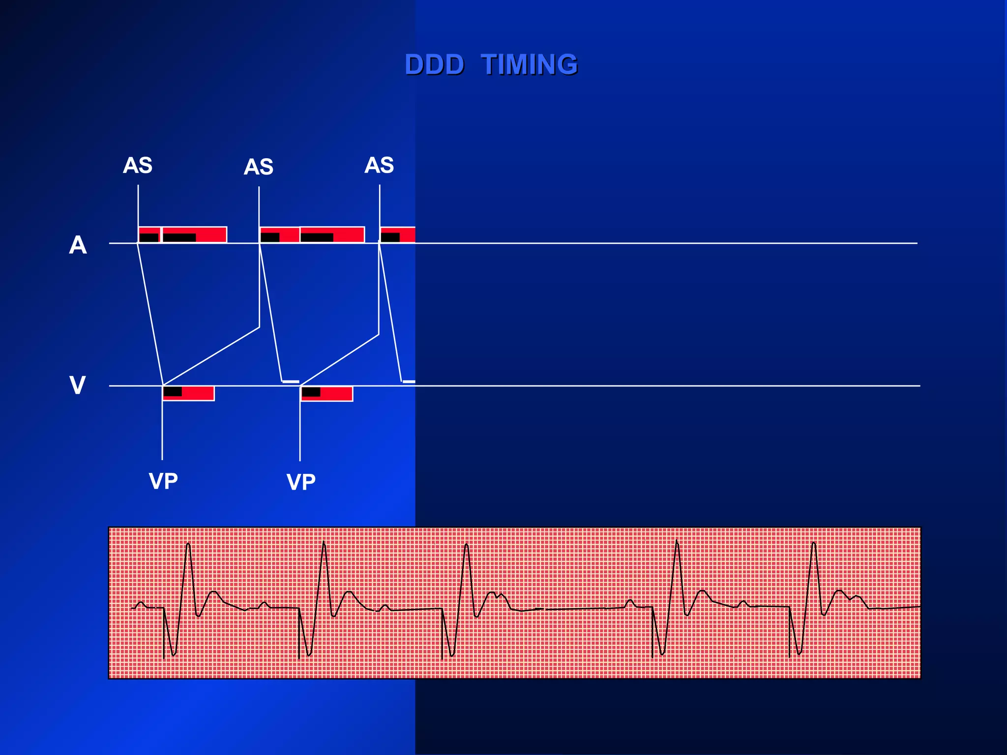 VP
AS
VP
AS ASAS AS AS
AR
VP VPVP
DDD TIMINGDDD TIMING
A
V
 