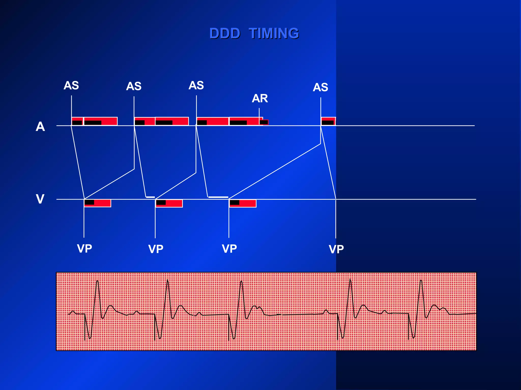 VP
AS
VP VP
AS ASAS
DDD TIMINGDDD TIMING
AS AS
AR
VP
A
V
VP
 