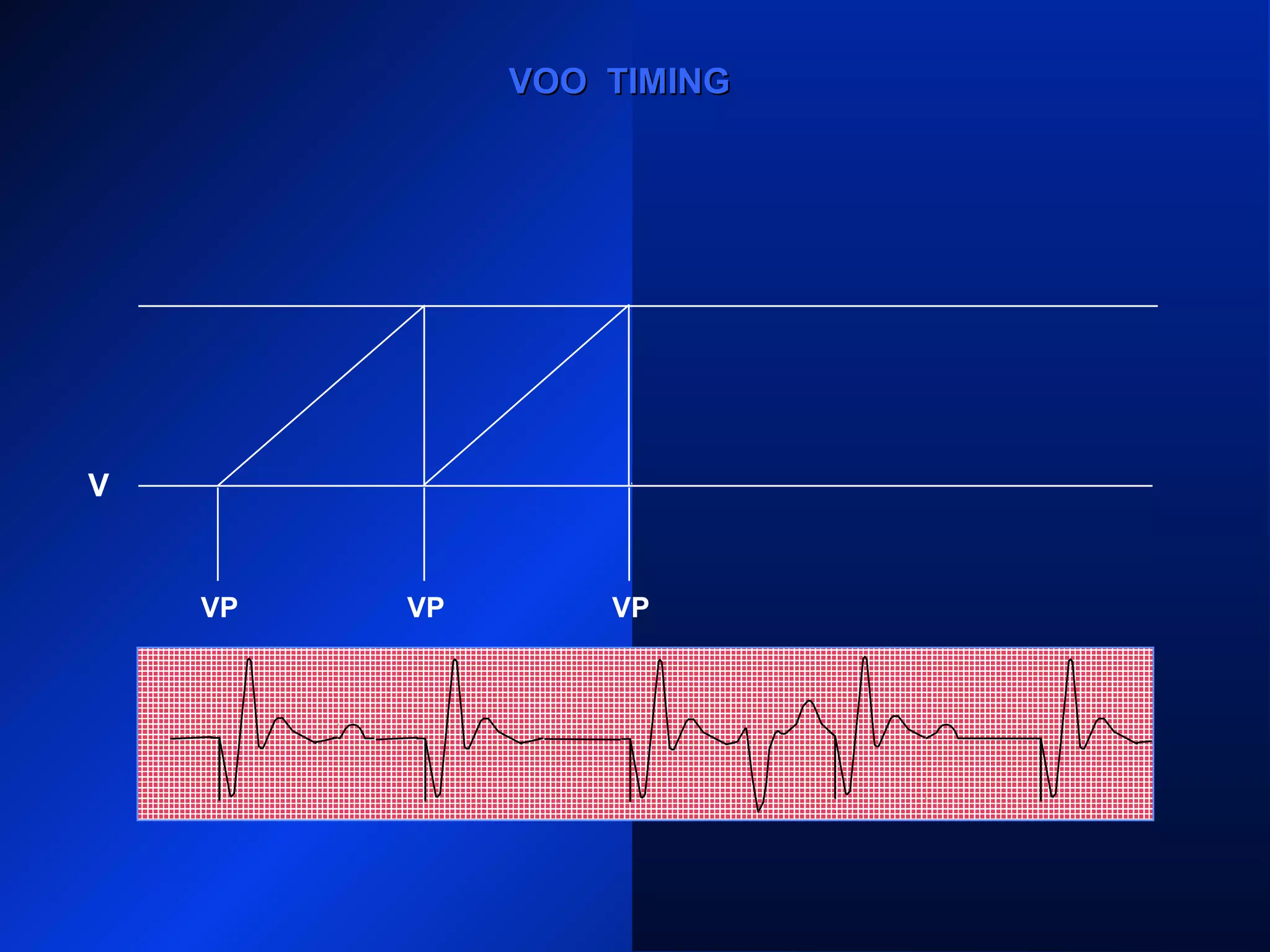 VP VP VPVPVP
VOO TIMINGVOO TIMING
V
 
