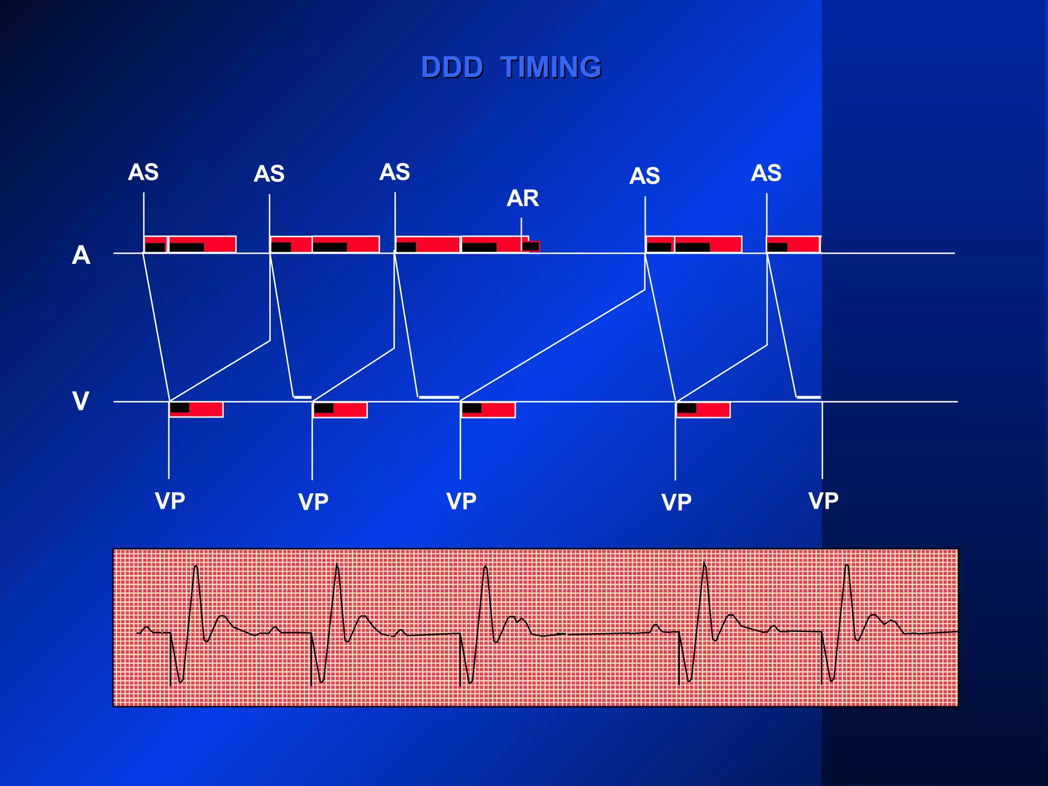 VP
AS
VP VP VP
AS ASAS
DDD TIMINGDDD TIMING
AS AS
AR
A
V
VP
 