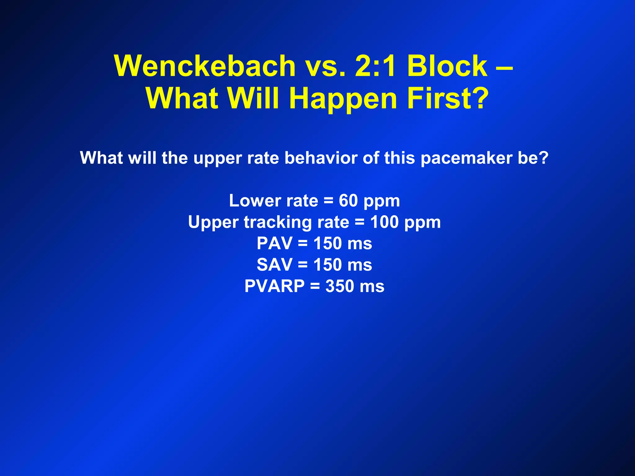 Wenckebach vs. 2:1 Block –
What Will Happen First?
What will the upper rate behavior of this pacemaker be?
Lower rate = 60 ppm
Upper tracking rate = 100 ppm
PAV = 150 ms
SAV = 150 ms
PVARP = 350 ms
 