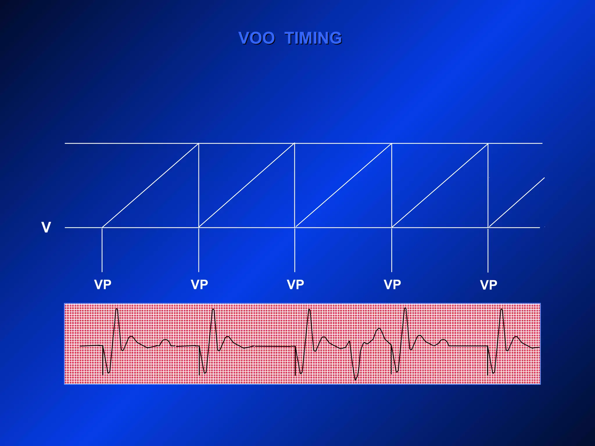 V
VP VPVP
VOO TIMINGVOO TIMING
VP VP
 