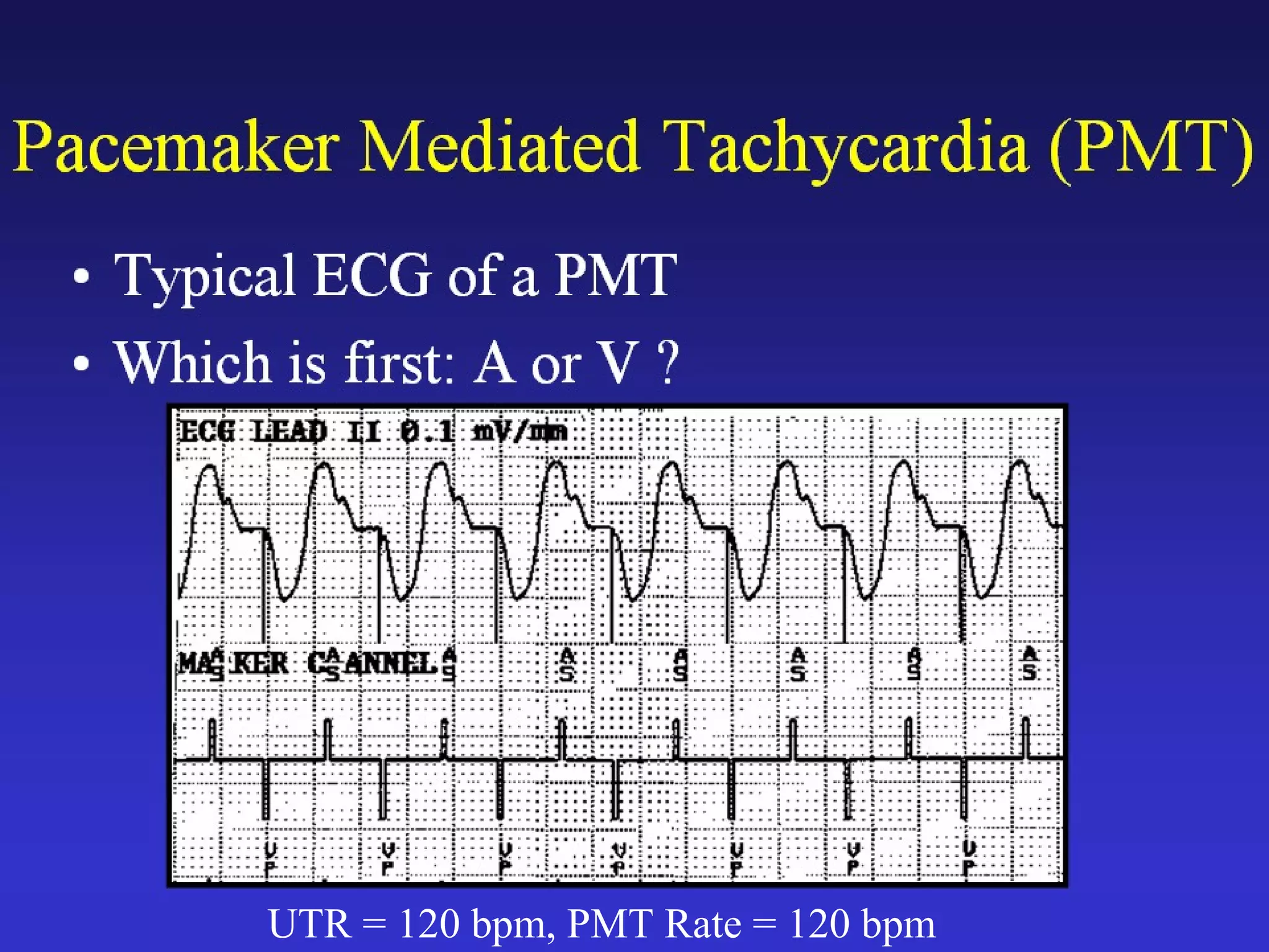 UTR = 120 bpm, PMT Rate = 120 bpm
 
