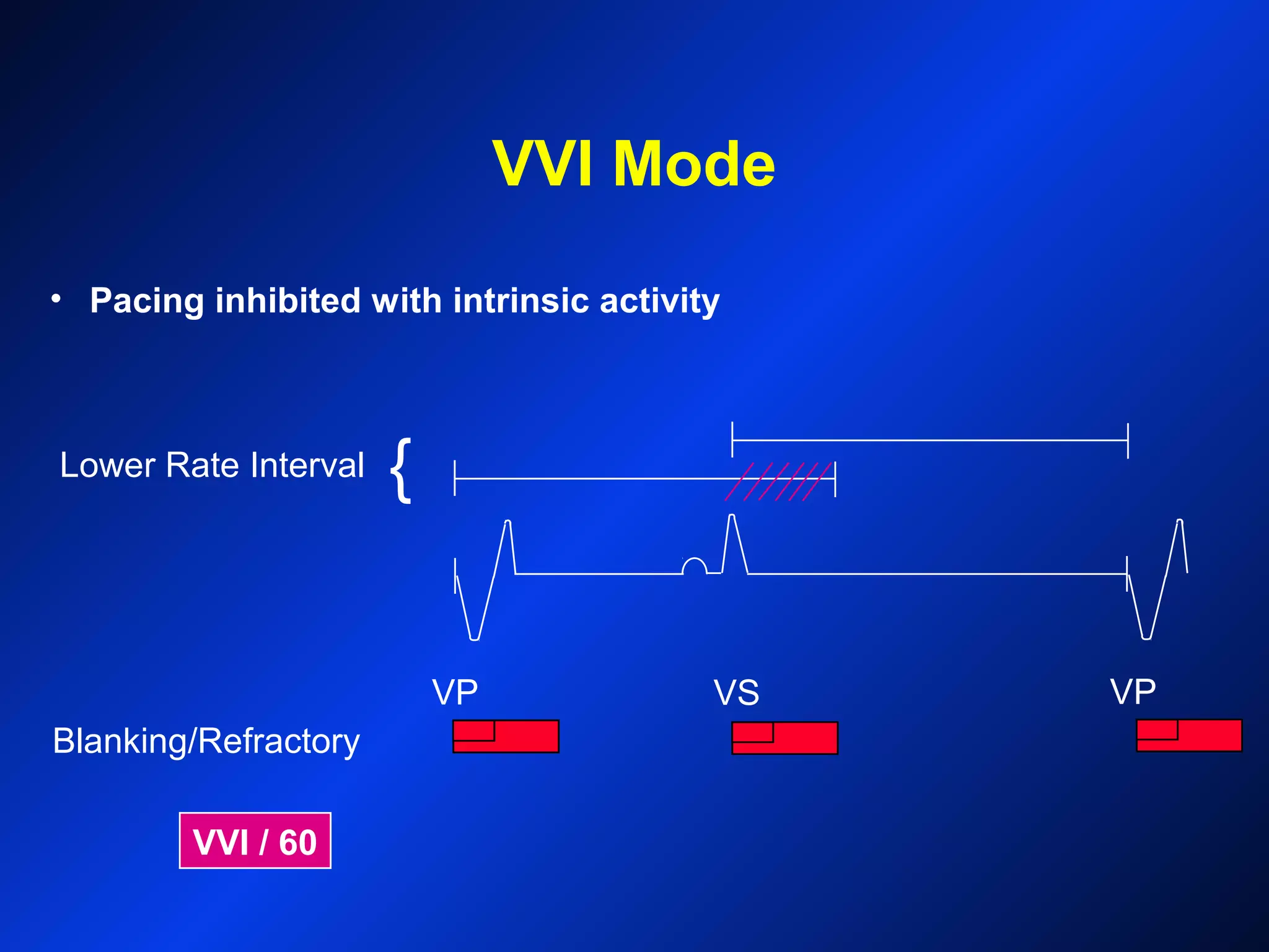 VVI Mode
Lower Rate Interval
VP VS
Blanking/Refractory
VP
{
VVI / 60
• Pacing inhibited with intrinsic activity
 