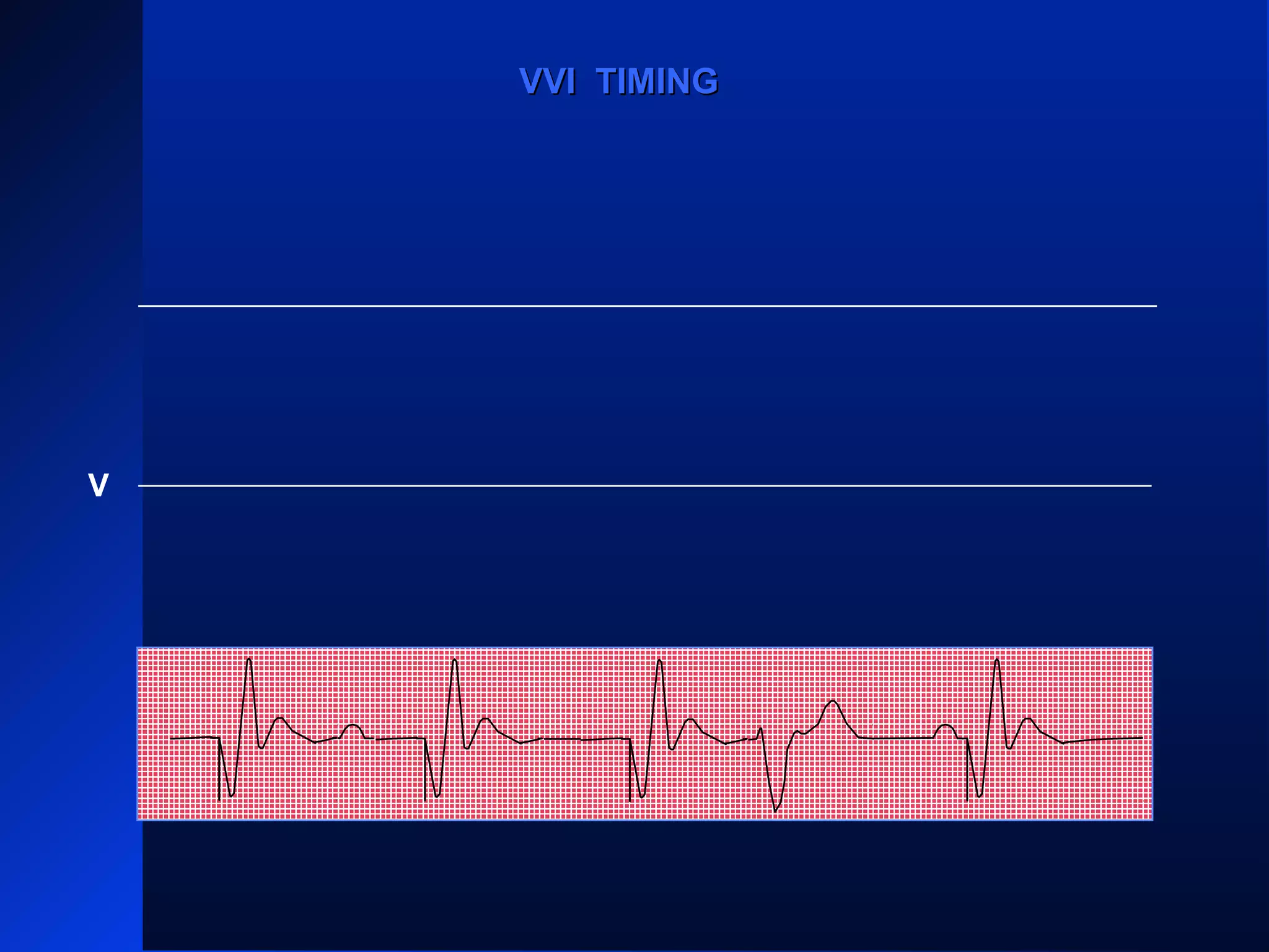 VP
VS
VPVPVP
VVI TIMINGVVI TIMING
V
 