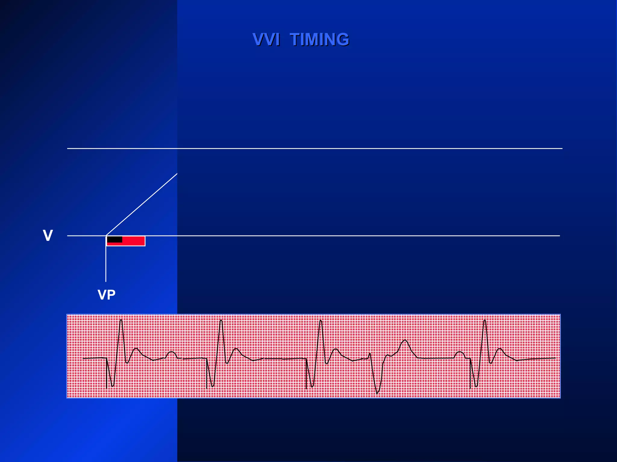 VP VP
VS
VPVP
V
VVI TIMINGVVI TIMING
 