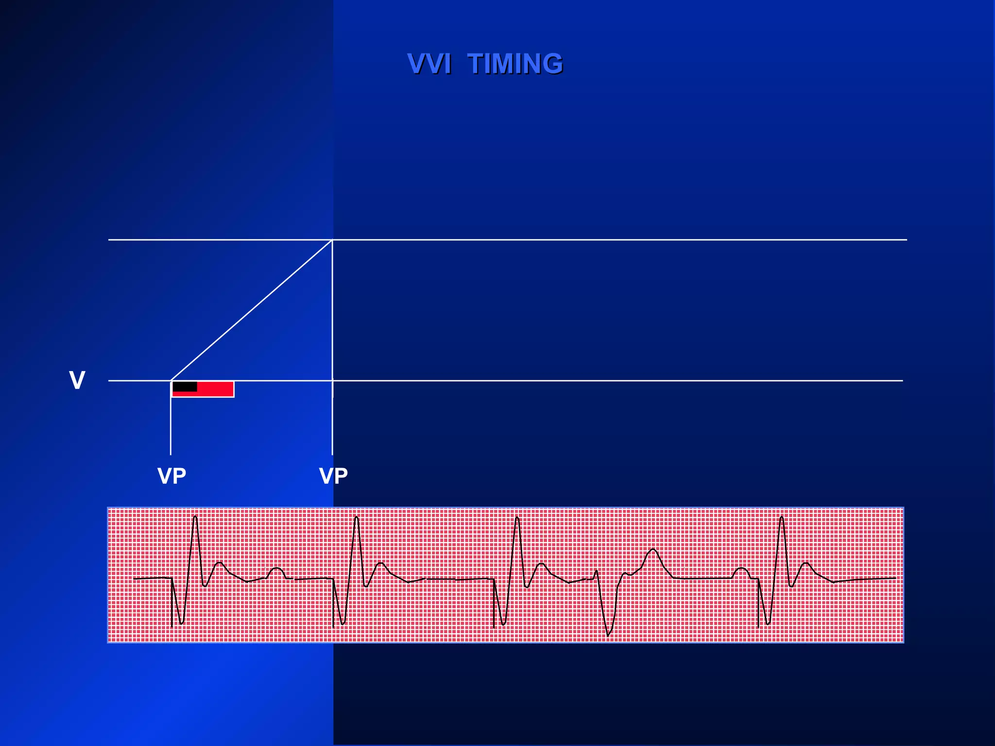VP VP
VS
VPVP
VVI TIMINGVVI TIMING
V
 