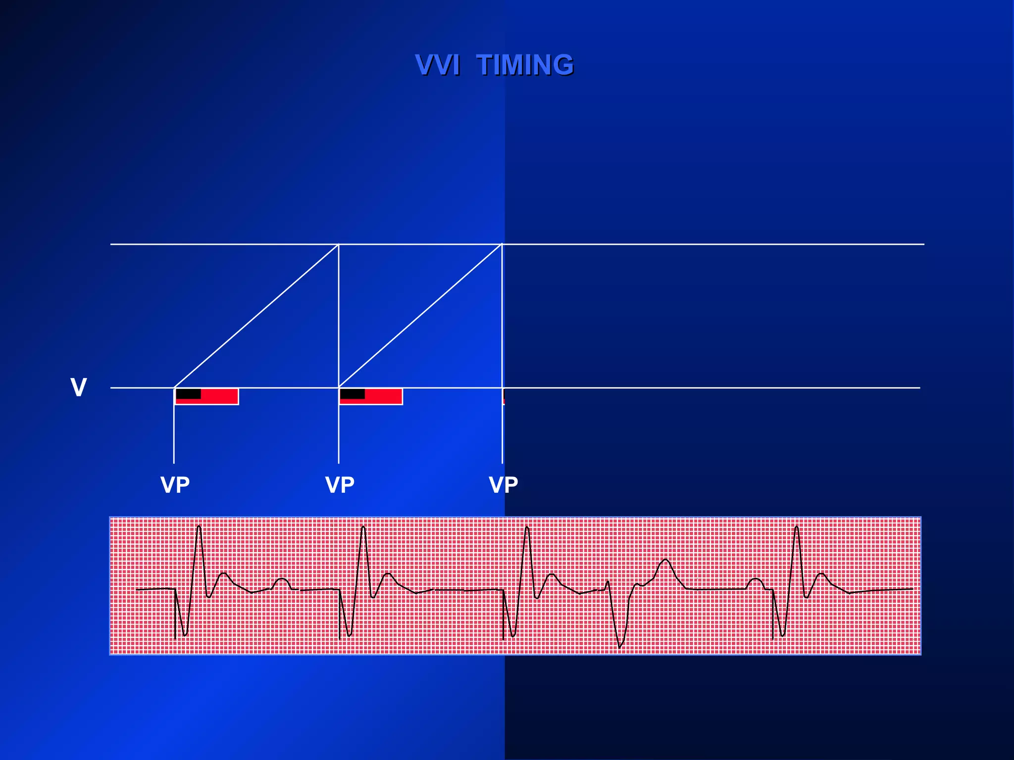 VP VP VP
VS
VVI TIMINGVVI TIMING
VP
V
 