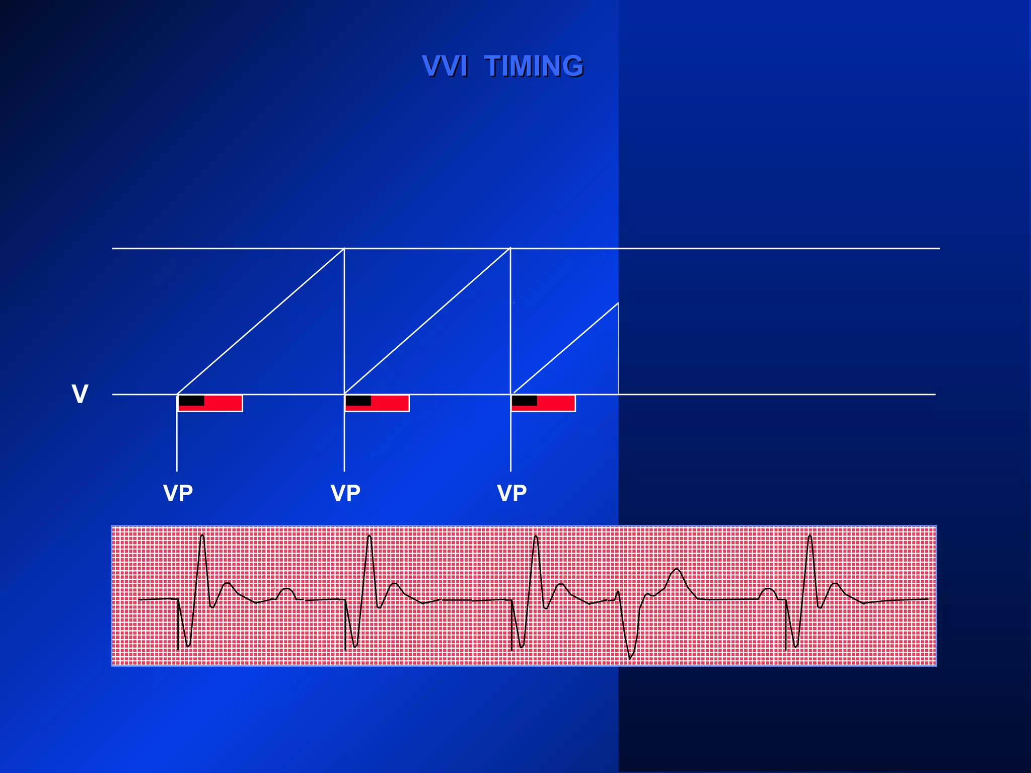 VP VPVP VP
VVI TIMINGVVI TIMING
V
 