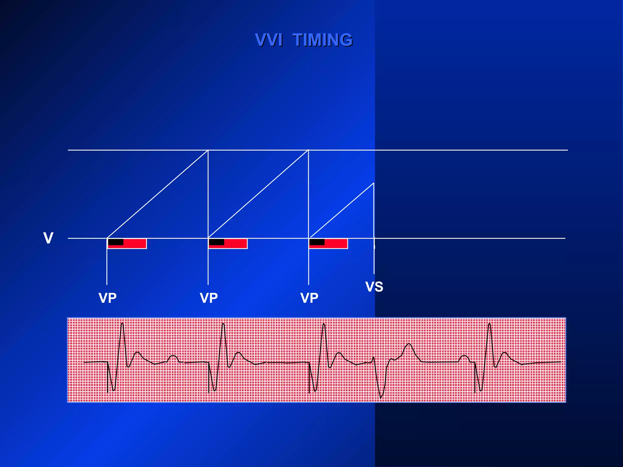 VP VPVP VP
VVI TIMINGVVI TIMING
V
VS
 