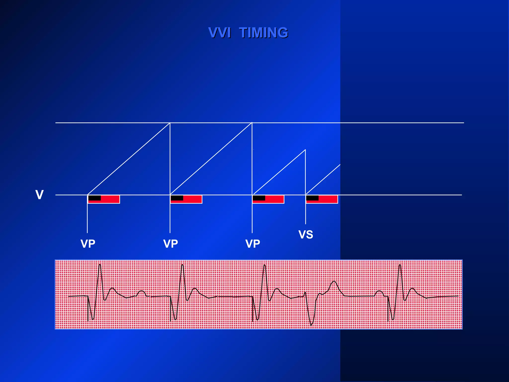 VP VPVP VP
VVI TIMINGVVI TIMING
V
VS
 