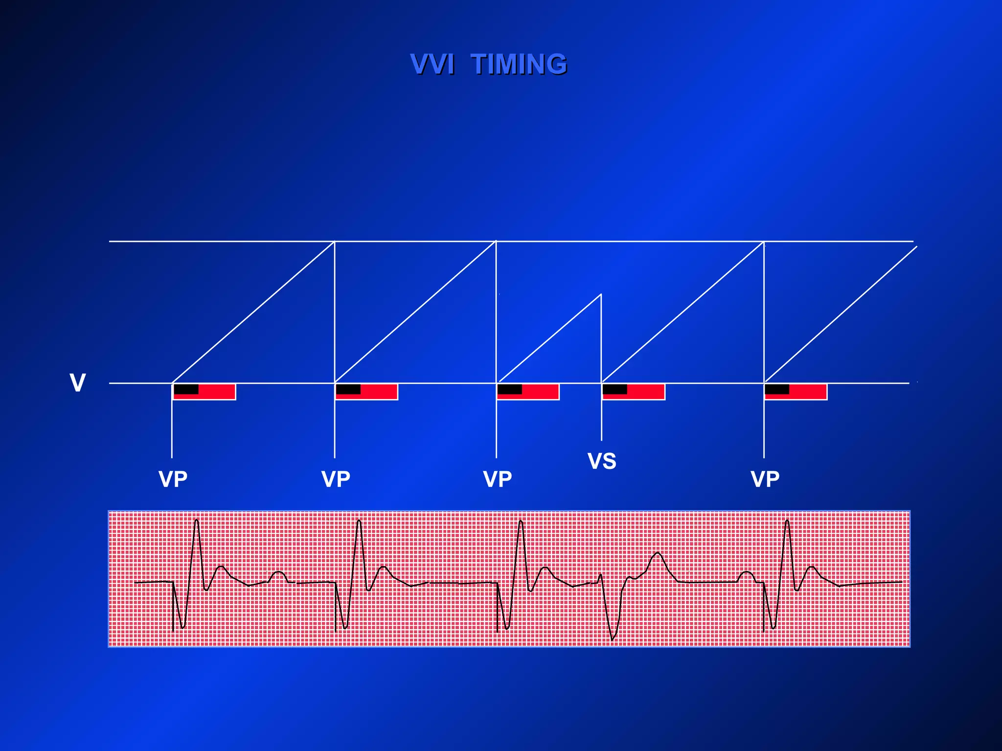 V
VP VPVP VP
VS
VVI TIMINGVVI TIMING
 