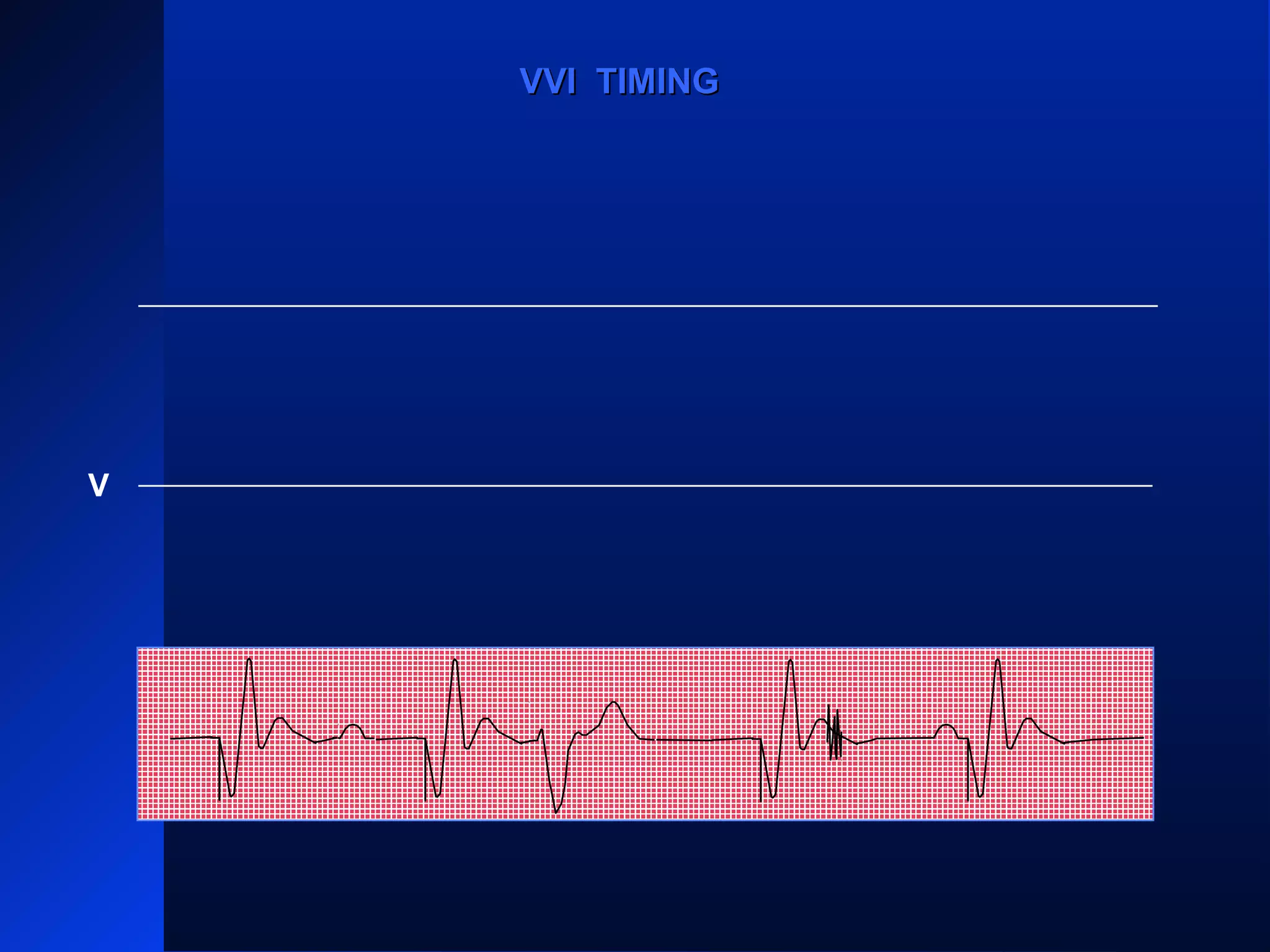 VPVP VPVP
V
VVI TIMINGVVI TIMING
 