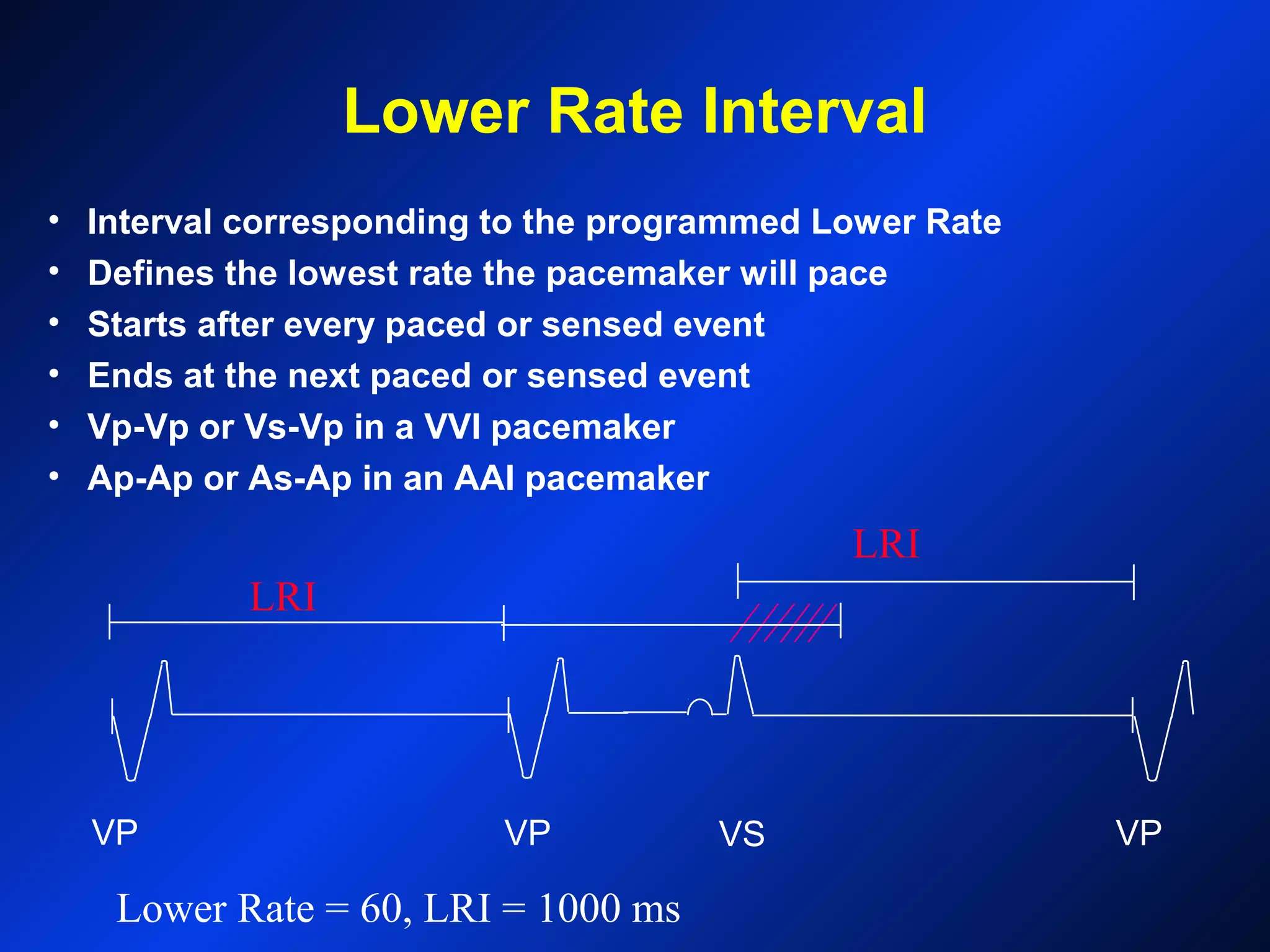 VP VP VS VP
Lower Rate Interval
• Interval corresponding to the programmed Lower Rate
• Defines the lowest rate the pacemaker will pace
• Starts after every paced or sensed event
• Ends at the next paced or sensed event
• Vp-Vp or Vs-Vp in a VVI pacemaker
• Ap-Ap or As-Ap in an AAI pacemaker
LRI
LRI
Lower Rate = 60, LRI = 1000 ms
 