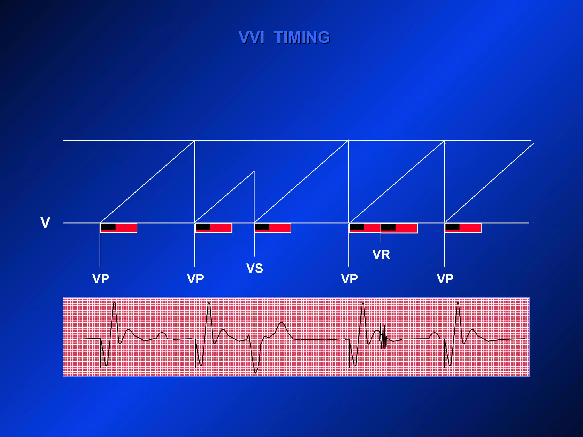 V
VVI TIMINGVVI TIMING
VP VP
VS
VP VP
VR
 