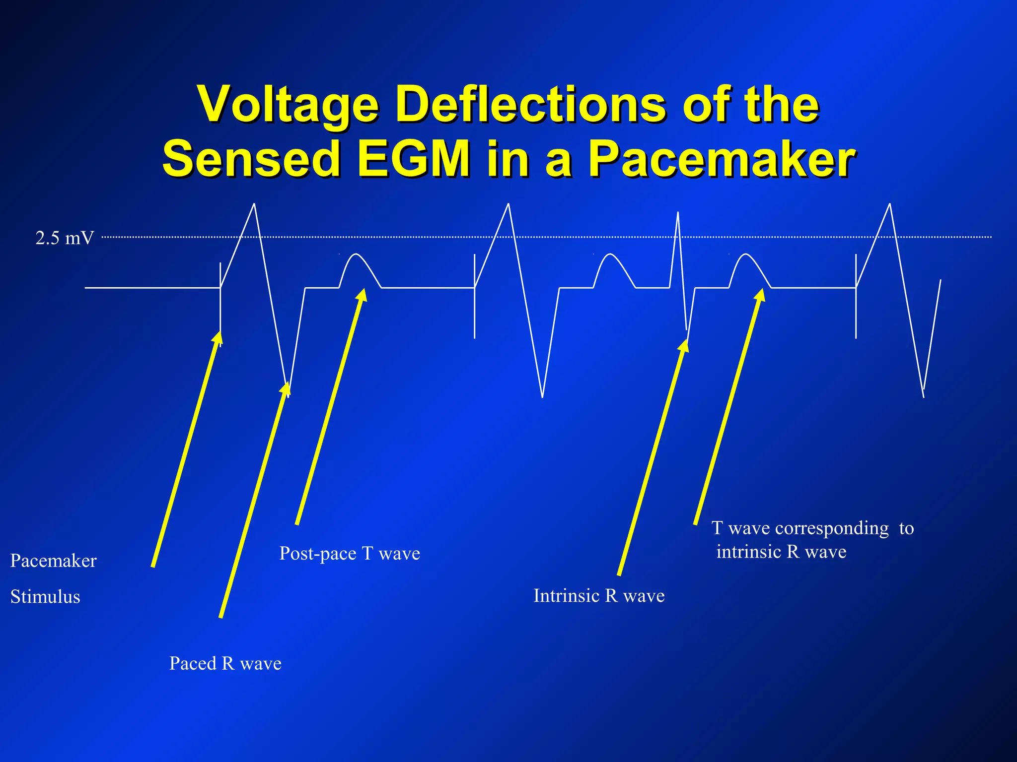Voltage Deflections of theVoltage Deflections of the
Sensed EGM in a PacemakerSensed EGM in a Pacemaker
Pacemaker
Stimulus
Paced R wave
Post-pace T wave
Intrinsic R wave
T wave corresponding to
intrinsic R wave
2.5 mV
 