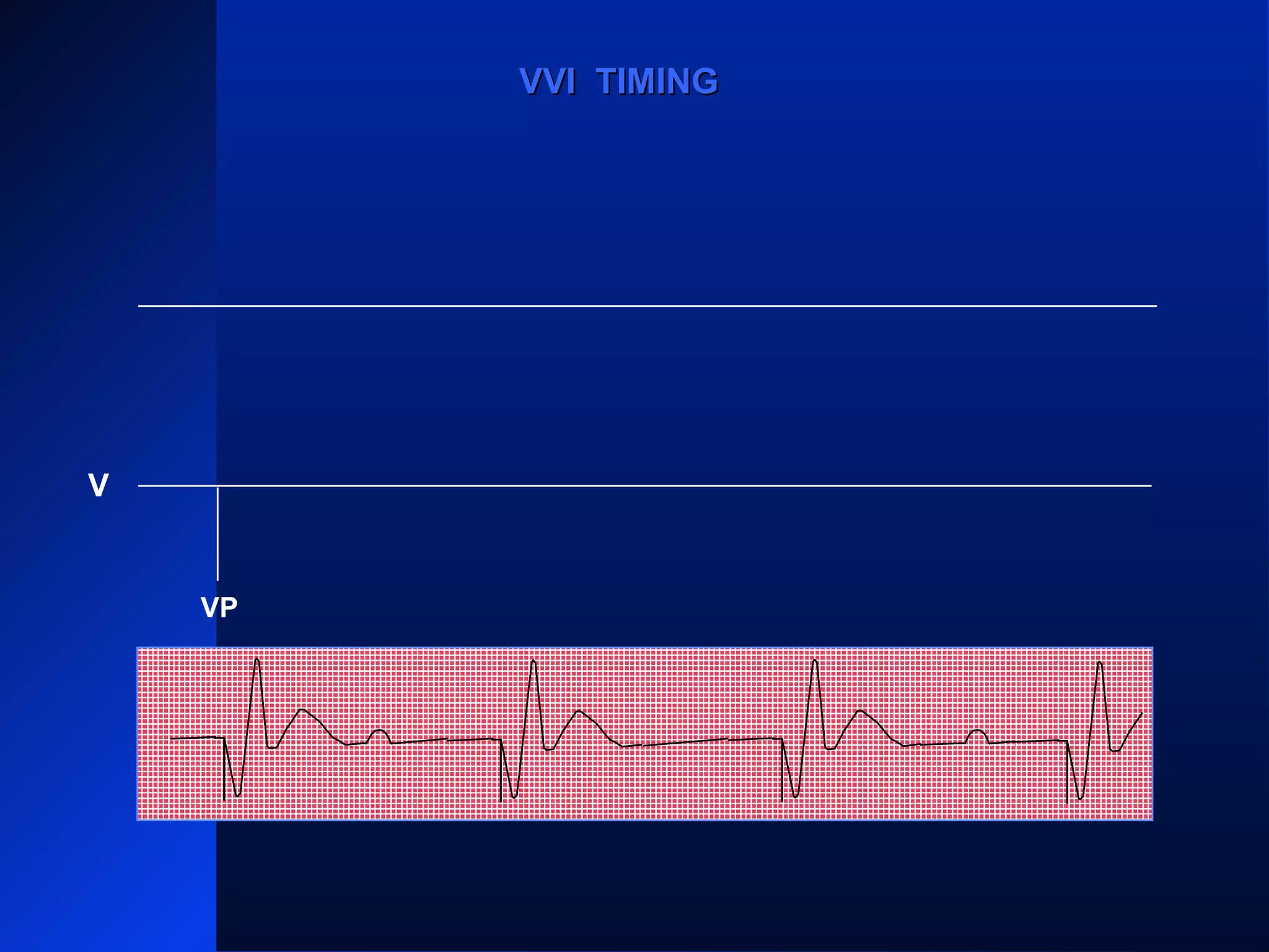 VP
VS
VPVP
VVI TIMINGVVI TIMING
V
VP
 