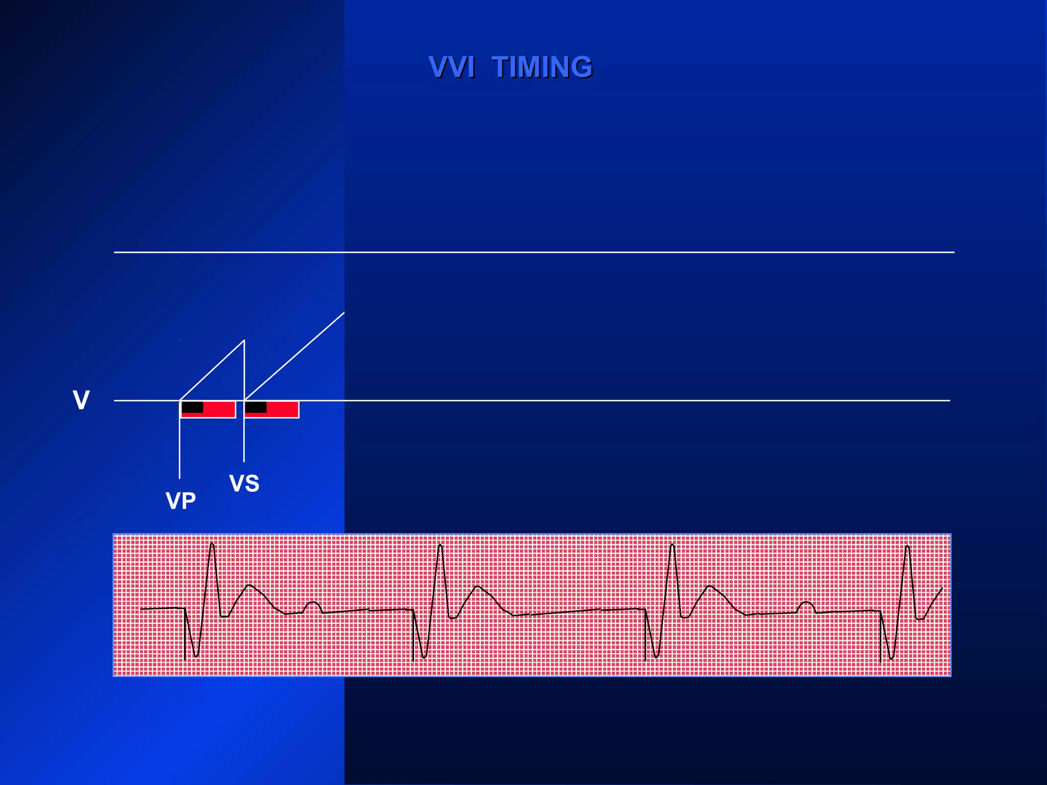 VP
VS
VP
VS
VPVP
VVI TIMINGVVI TIMING
V
 