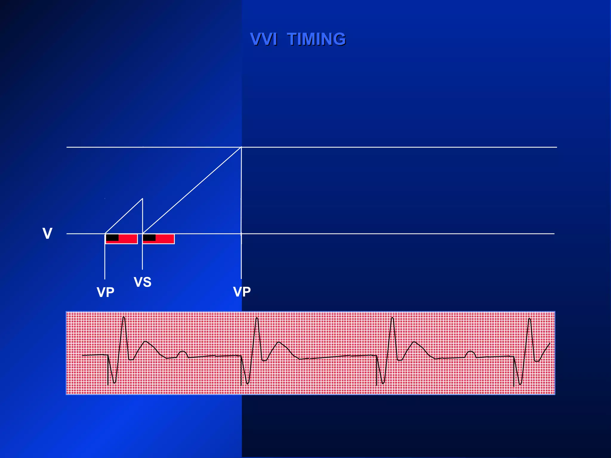 VP
VS
VP
VS
VP
VVI TIMINGVVI TIMING
V
VP
 