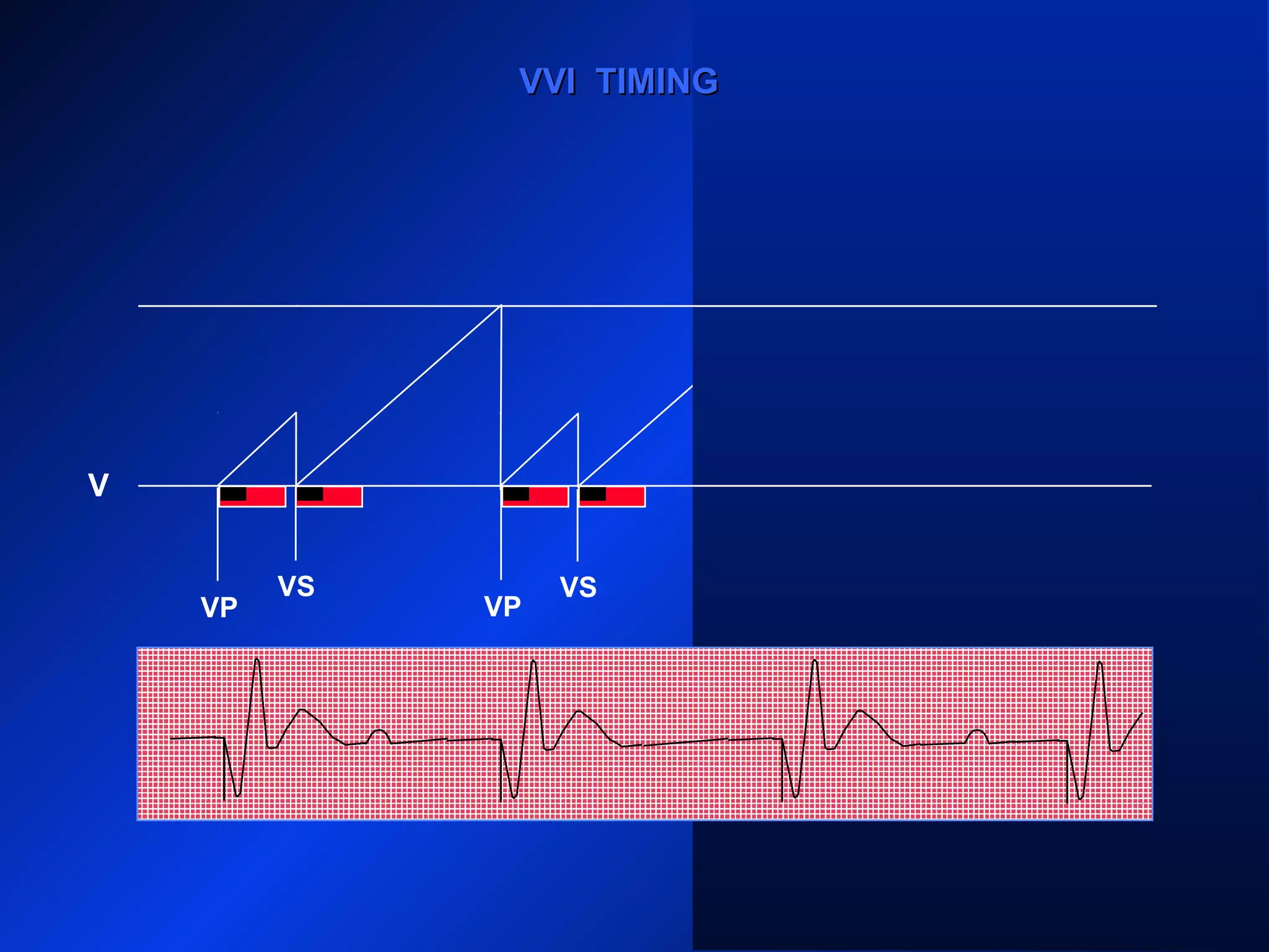 VP VP
VS VS
VP
VS
VP
VVI TIMINGVVI TIMING
V
 