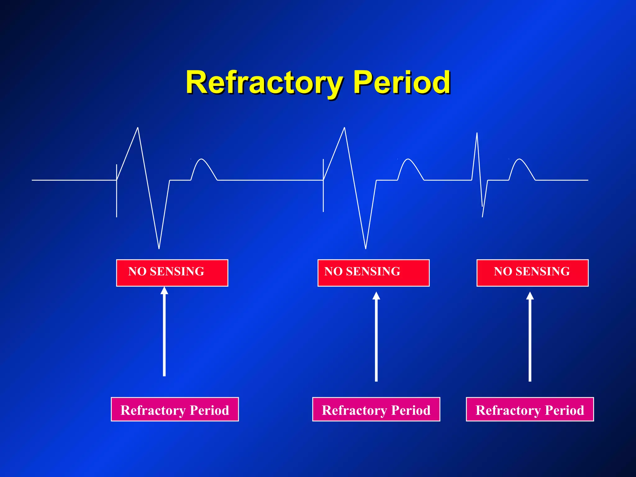 Refractory PeriodRefractory Period
Refractory Period Refractory Period Refractory Period
NO SENSING NO SENSING NO SENSING
 