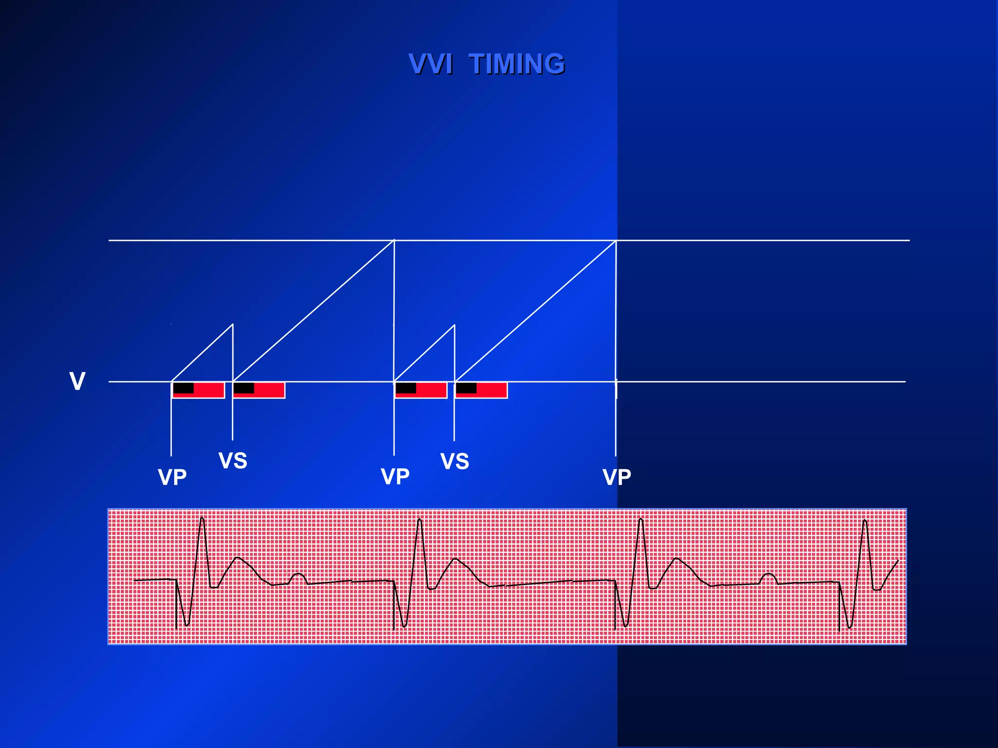 VP VP
VS VS
VP
VS
VVI TIMINGVVI TIMING
V
VP
 