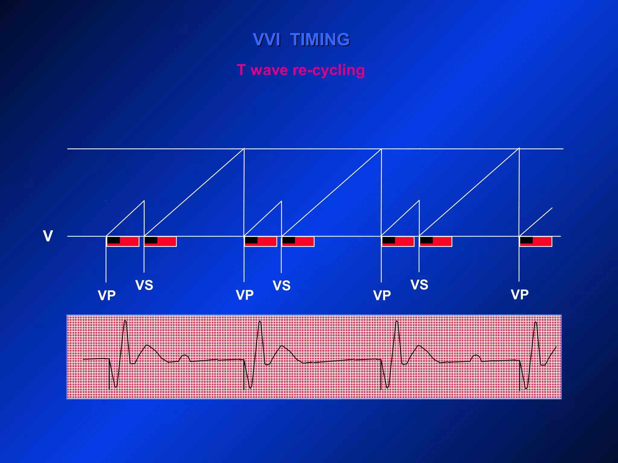 V
VVI TIMINGVVI TIMING
VP VP
VS
VP
VS
VP
VS
T wave re-cycling
 