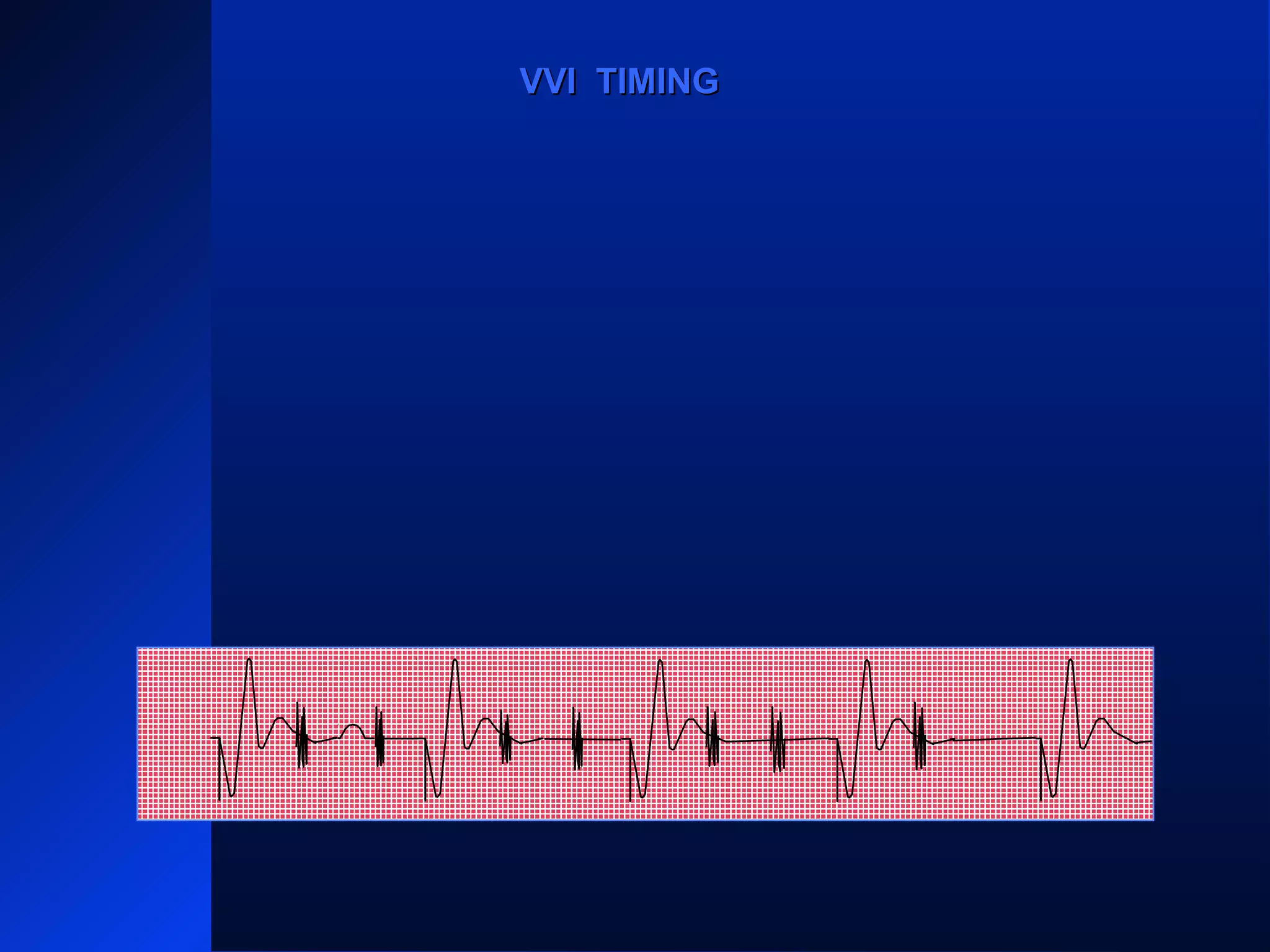 VP
VR VR VRVR VR
VPVP
VVI TIMINGVVI TIMING
 