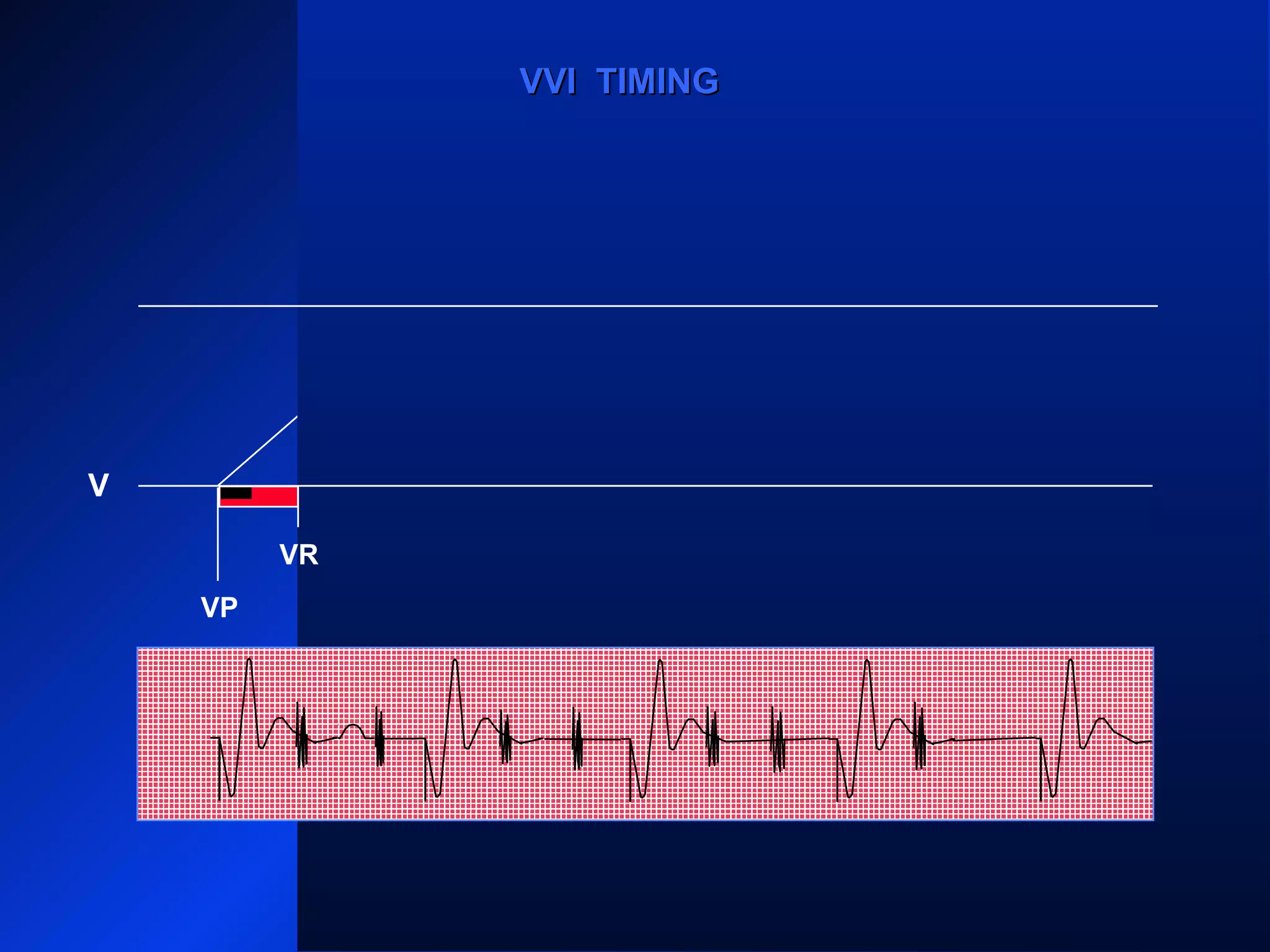VP VP
VR VR VRVR VR
VPVP
VVI TIMINGVVI TIMING
V
VR
 