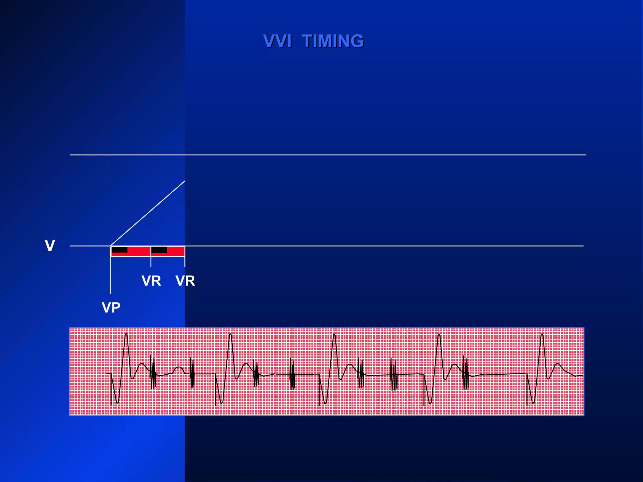VP VP
VRVR VR VRVR VR
VPVP
VVI TIMINGVVI TIMING
V
VR
 