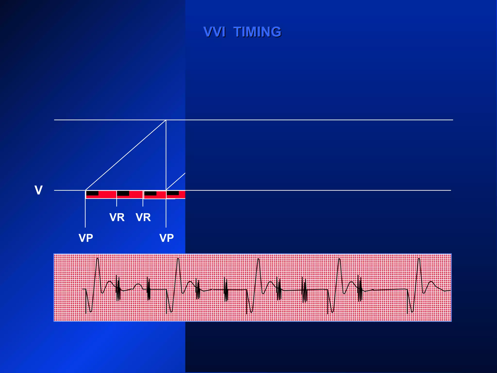 VP VP VP
VRVR VR VRVR VR
VPVP
VVI TIMINGVVI TIMING
V
VR
 