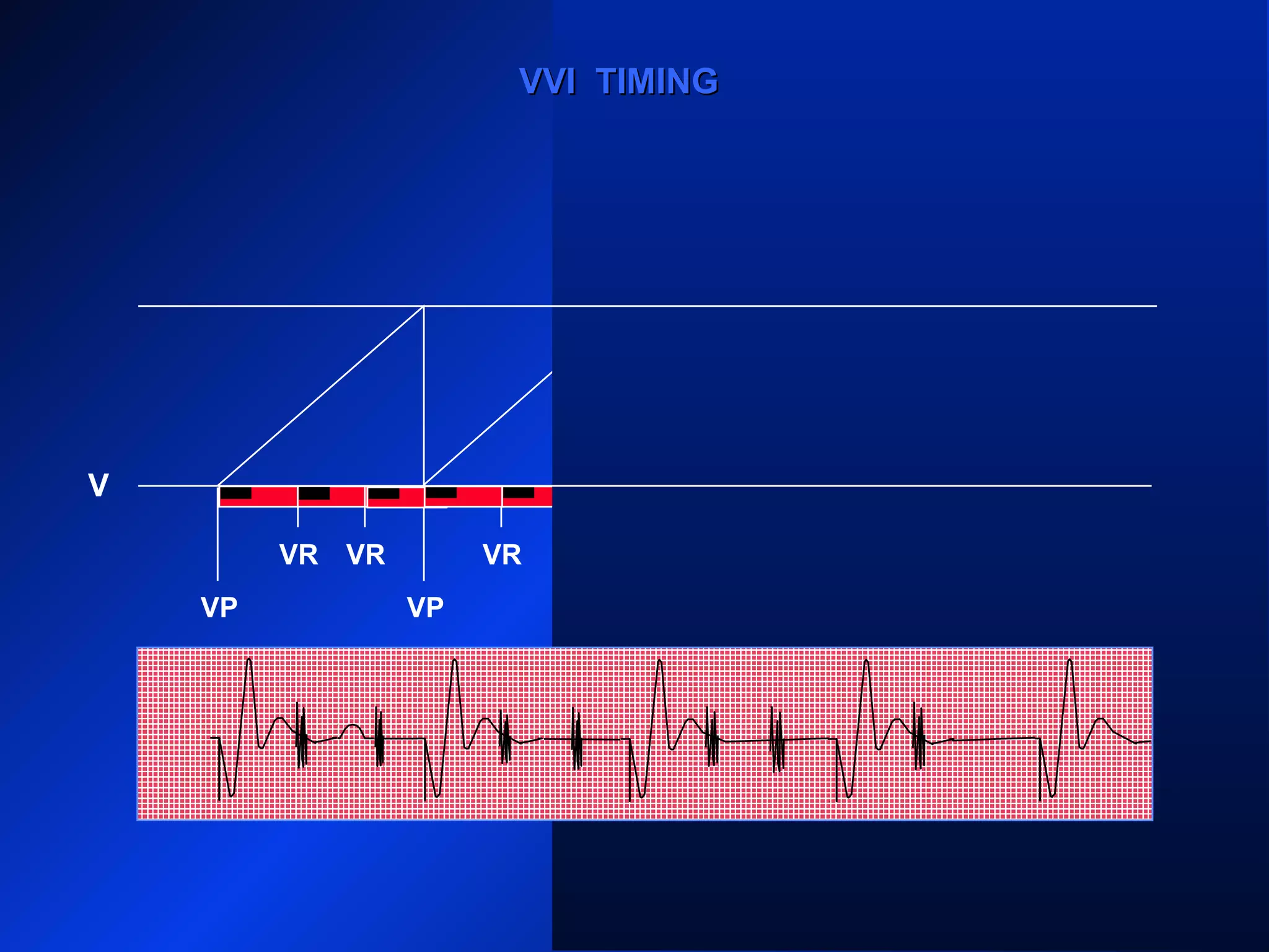 VP VP VP
VRVR VR VRVR VR
VPVP
VVI TIMINGVVI TIMING
V
VR
 