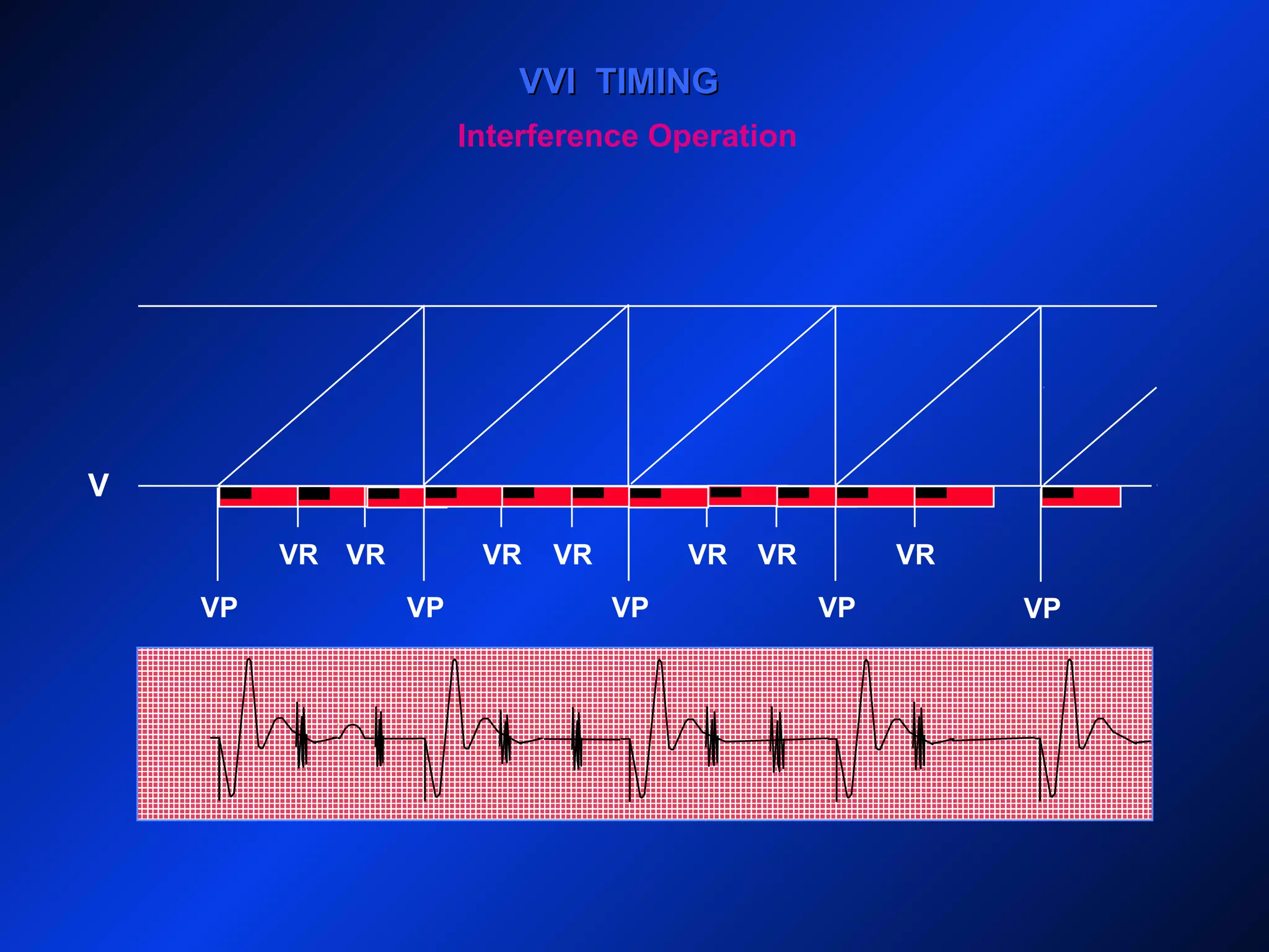 V
VP VPVP
VVI TIMINGVVI TIMING
VP VP
VRVR VR VRVR VR
Interference Operation
VR
 