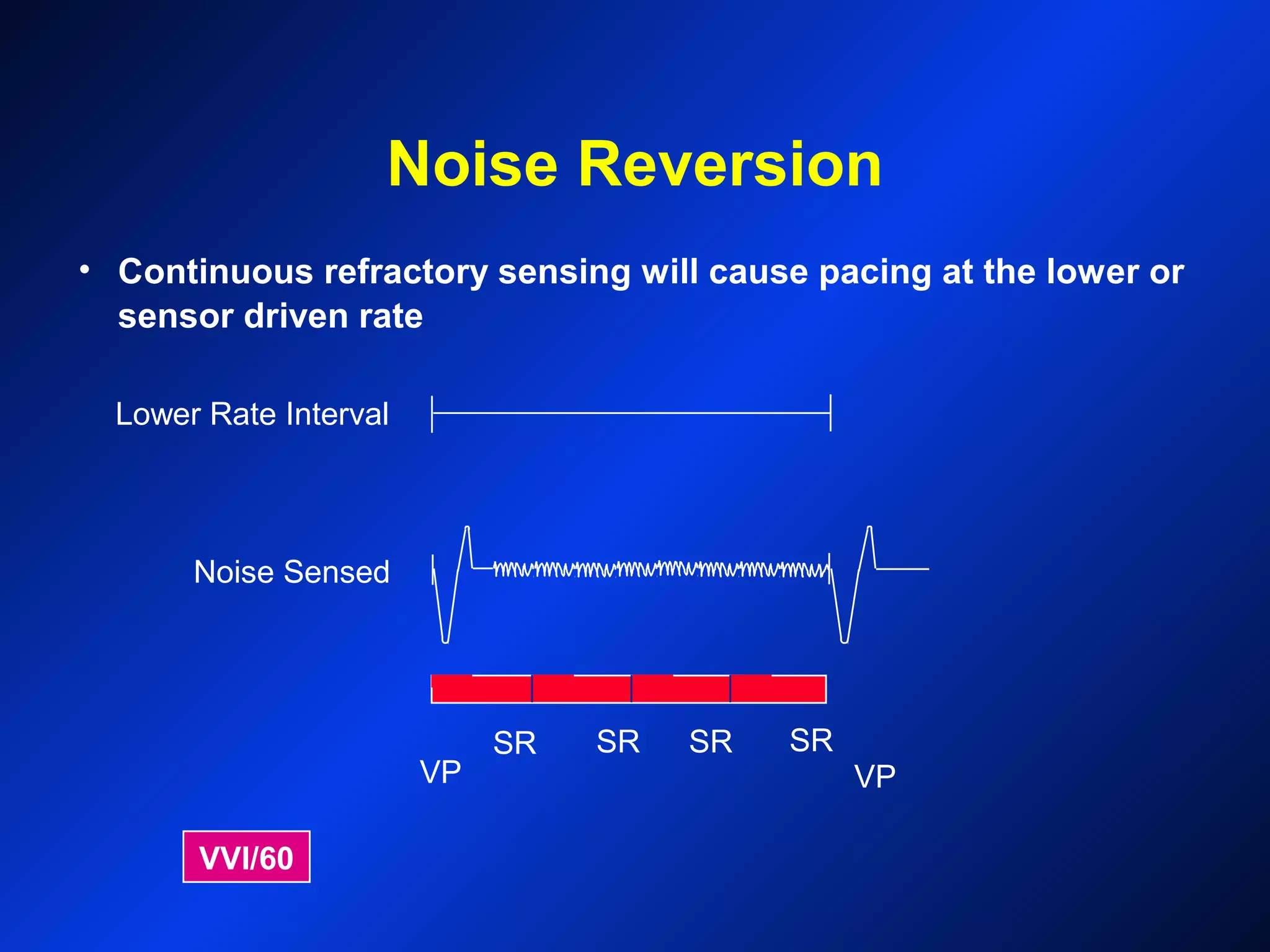Noise Reversion
VPVP
SRSR SR SR
Noise Sensed
Lower Rate Interval
VVI/60
• Continuous refractory sensing will cause pacing at the lower or
sensor driven rate
 