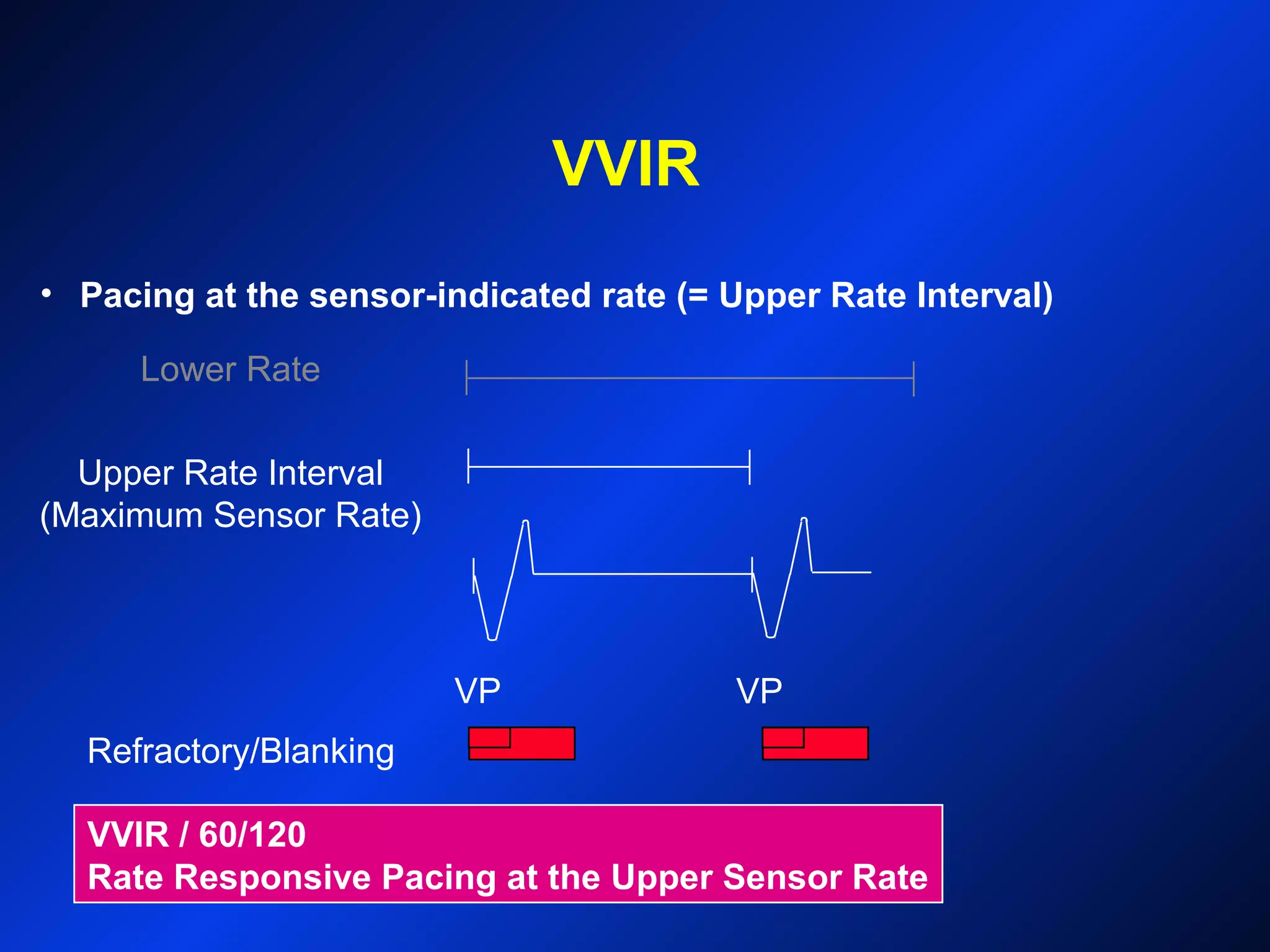 VVIR
VP VP
Refractory/Blanking
Lower Rate
Upper Rate Interval
(Maximum Sensor Rate)
VVIR / 60/120
Rate Responsive Pacing at the Upper Sensor Rate
• Pacing at the sensor-indicated rate (= Upper Rate Interval)
 