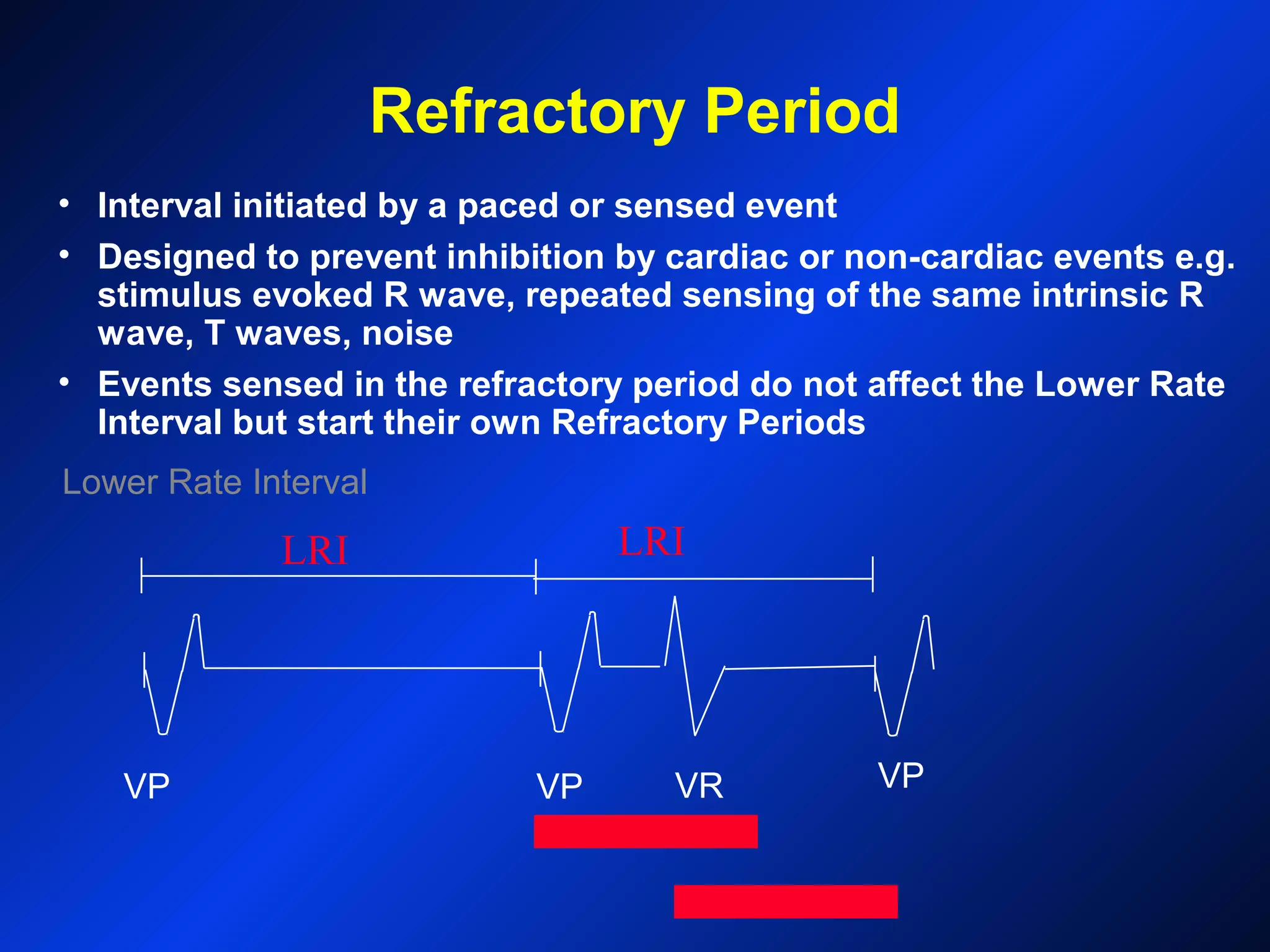 Refractory Period
Lower Rate Interval
• Interval initiated by a paced or sensed event
• Designed to prevent inhibition by cardiac or non-cardiac events e.g.
stimulus evoked R wave, repeated sensing of the same intrinsic R
wave, T waves, noise
• Events sensed in the refractory period do not affect the Lower Rate
Interval but start their own Refractory Periods
VP VP VR VP
LRI LRI
 