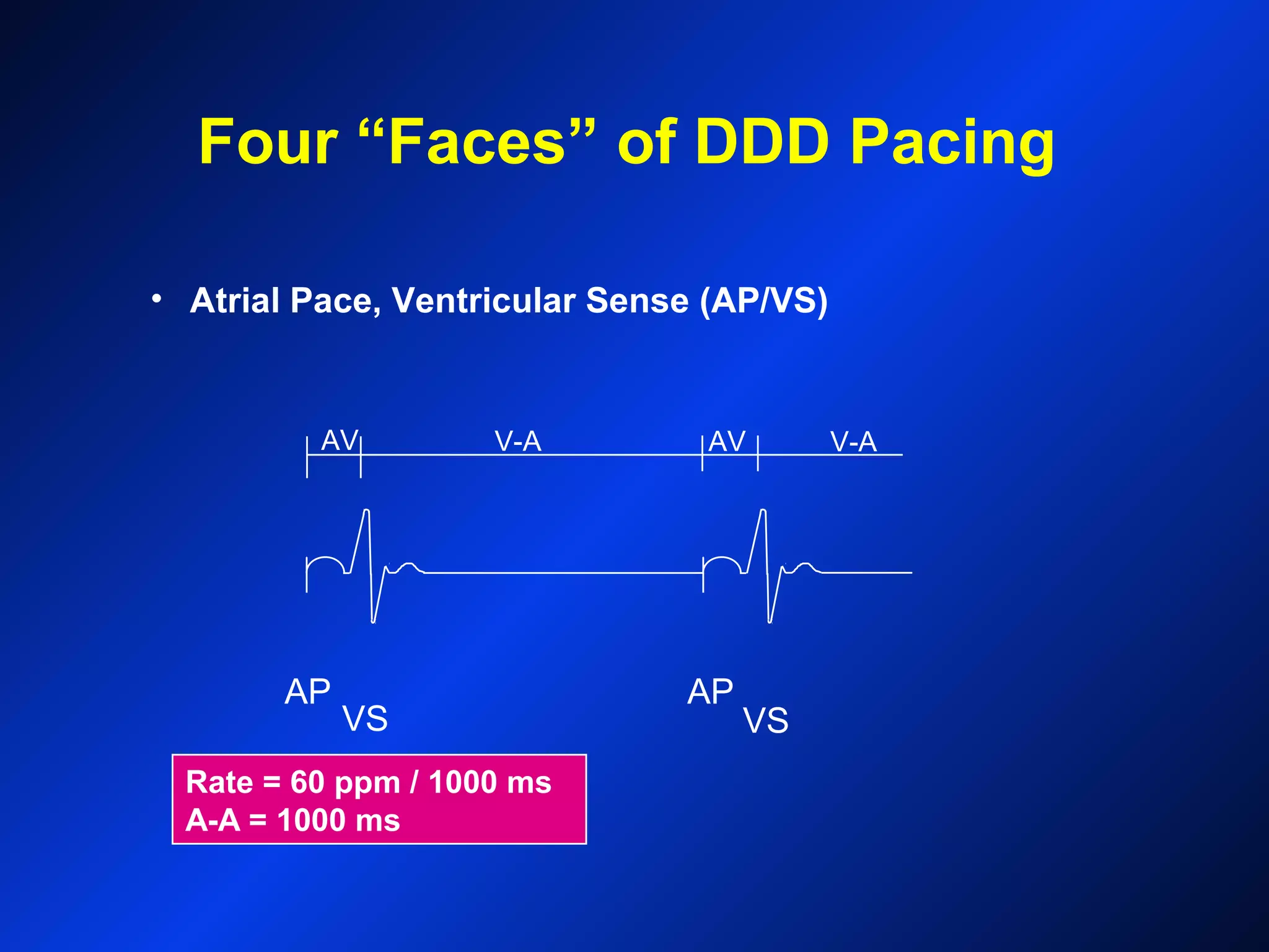 Rate = 60 ppm / 1000 ms
A-A = 1000 ms
AP
VS
AP
VS
V-AAV V-AAV
• Atrial Pace, Ventricular Sense (AP/VS)
Four “Faces” of DDD Pacing
 