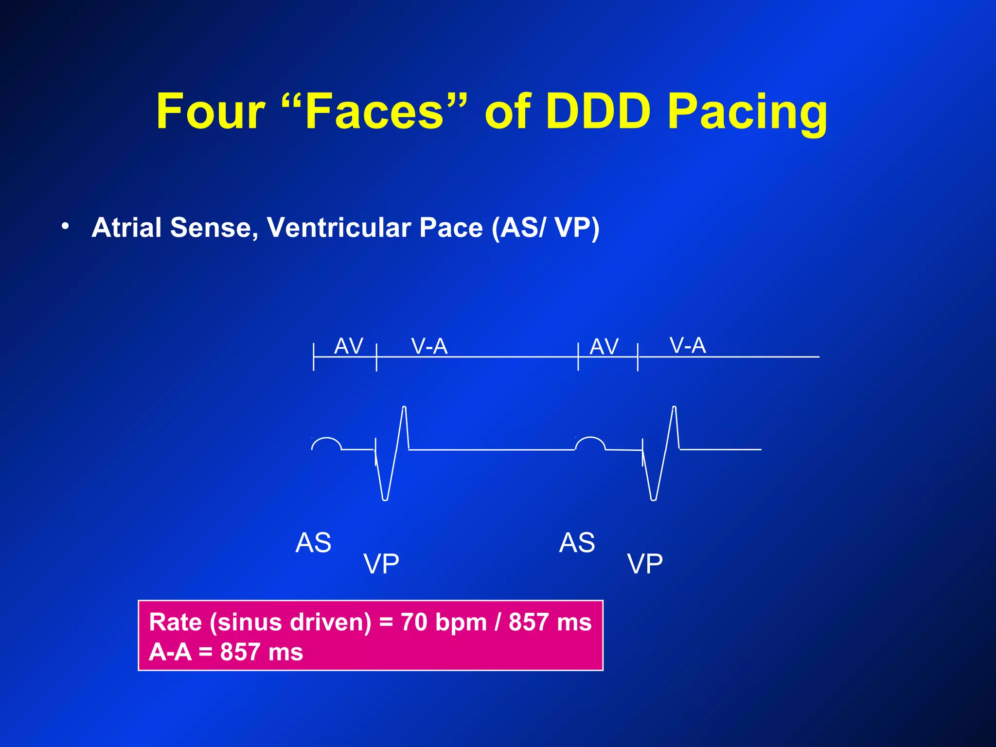 AS
VP
AS
VP
Rate (sinus driven) = 70 bpm / 857 ms
A-A = 857 ms
• Atrial Sense, Ventricular Pace (AS/ VP)
V-AAV AV V-A
Four “Faces” of DDD Pacing
 