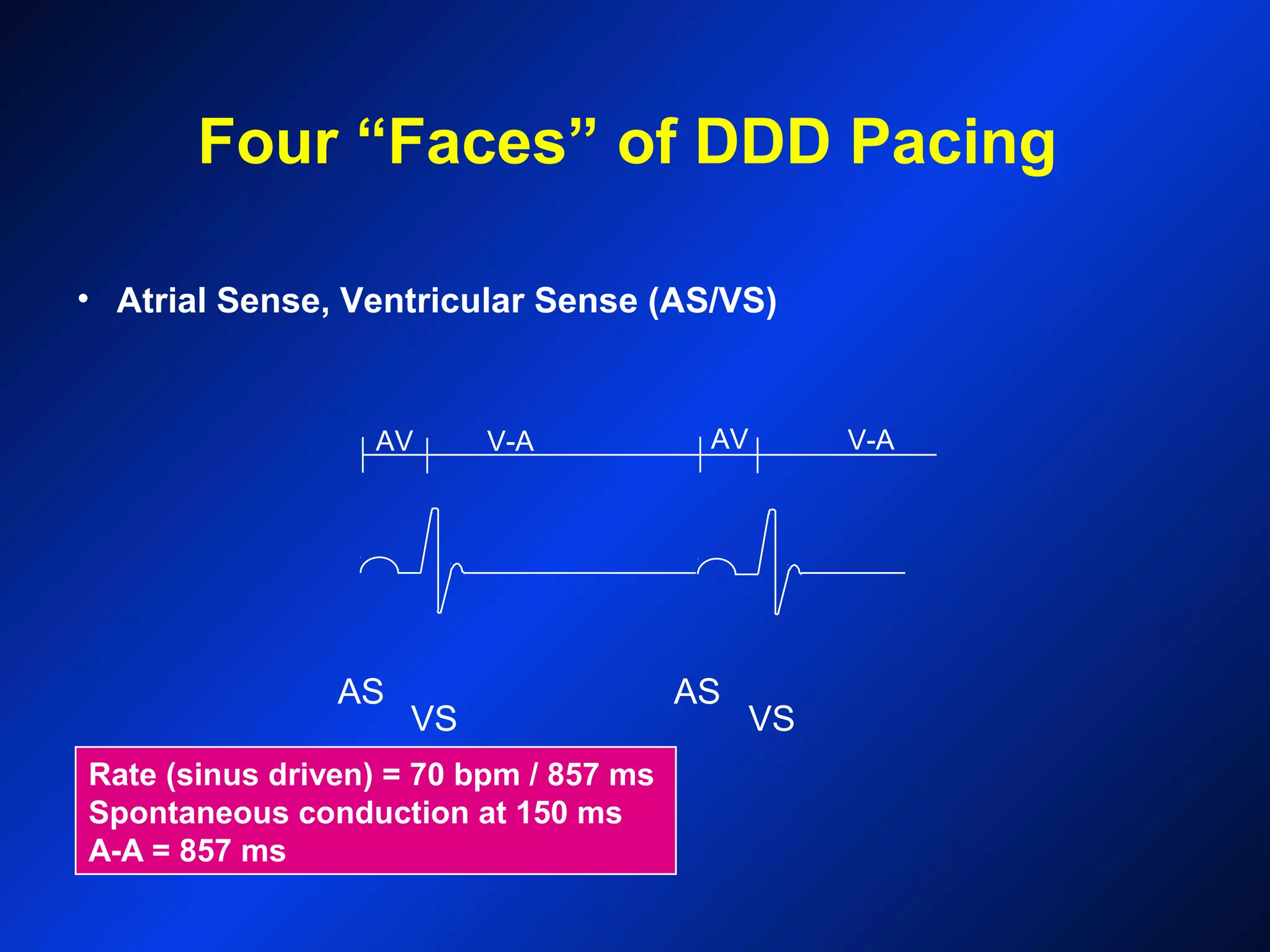Rate (sinus driven) = 70 bpm / 857 ms
Spontaneous conduction at 150 ms
A-A = 857 ms
AS
VS
AS
VS
V-AAV AV V-A
• Atrial Sense, Ventricular Sense (AS/VS)
Four “Faces” of DDD Pacing
 