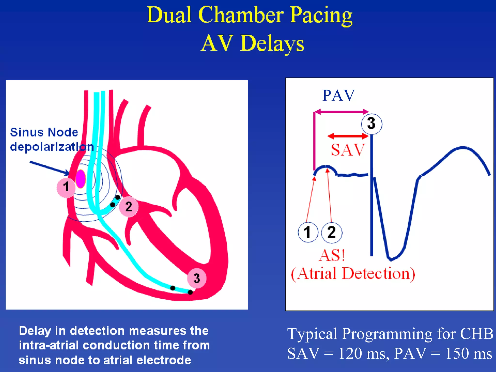 PAV
Typical Programming for CHB
SAV = 120 ms, PAV = 150 ms
 